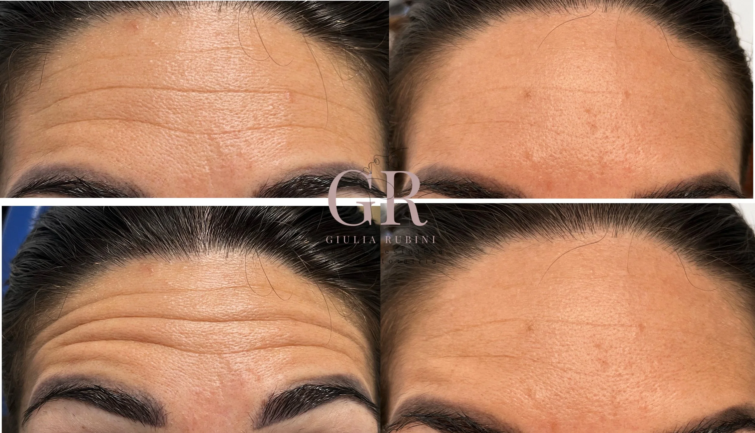 Collage prima e dopo botox fronte con la Dott.ssa Giulia Rubini, viso rilassato e naturale a Rimini