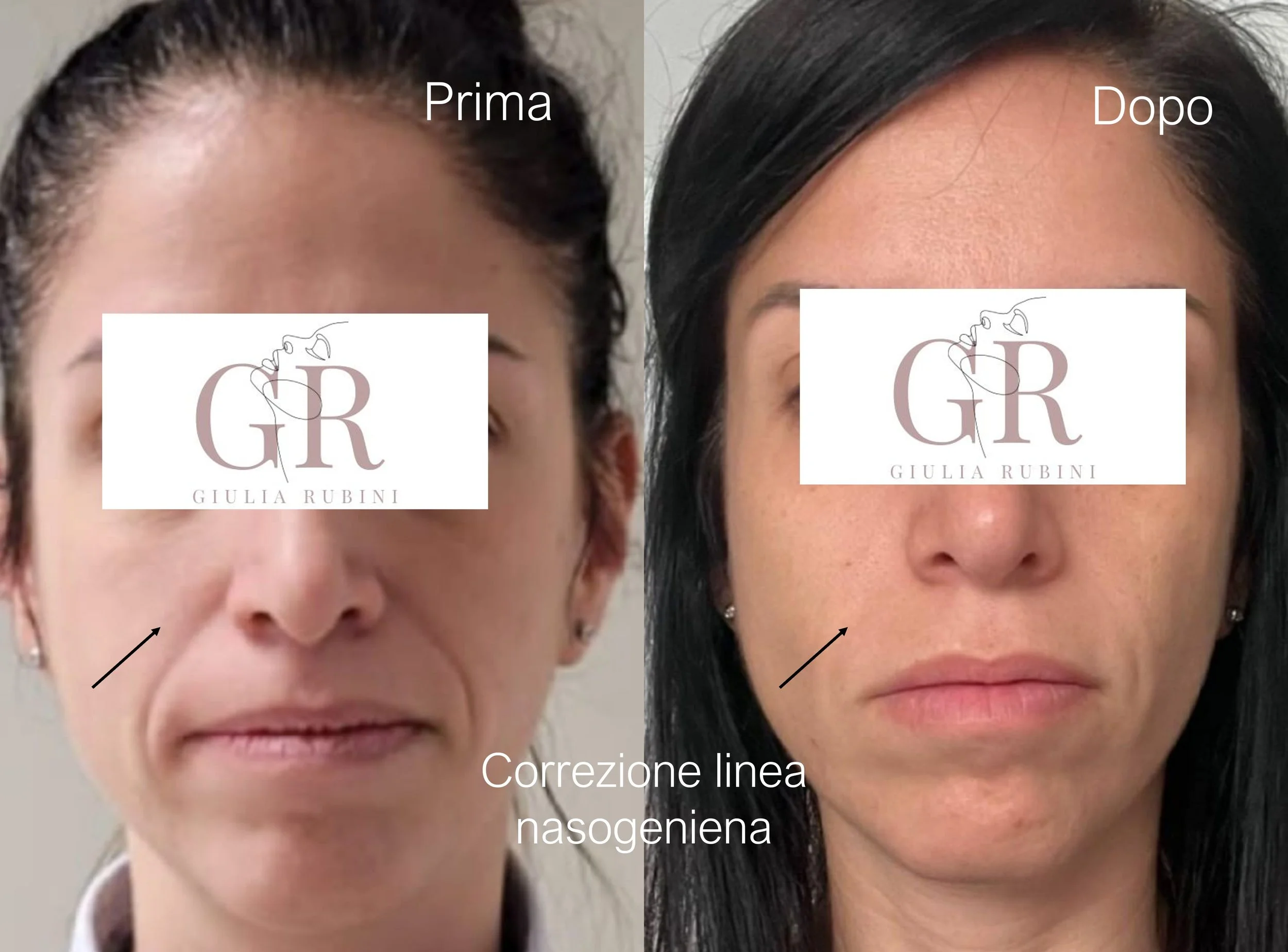 Collage prima e dopo correzione linea nasogeniena con filler, trattamento estetico naturale con la Dott.ssa Giulia Rubini tra Romagna e Marche.