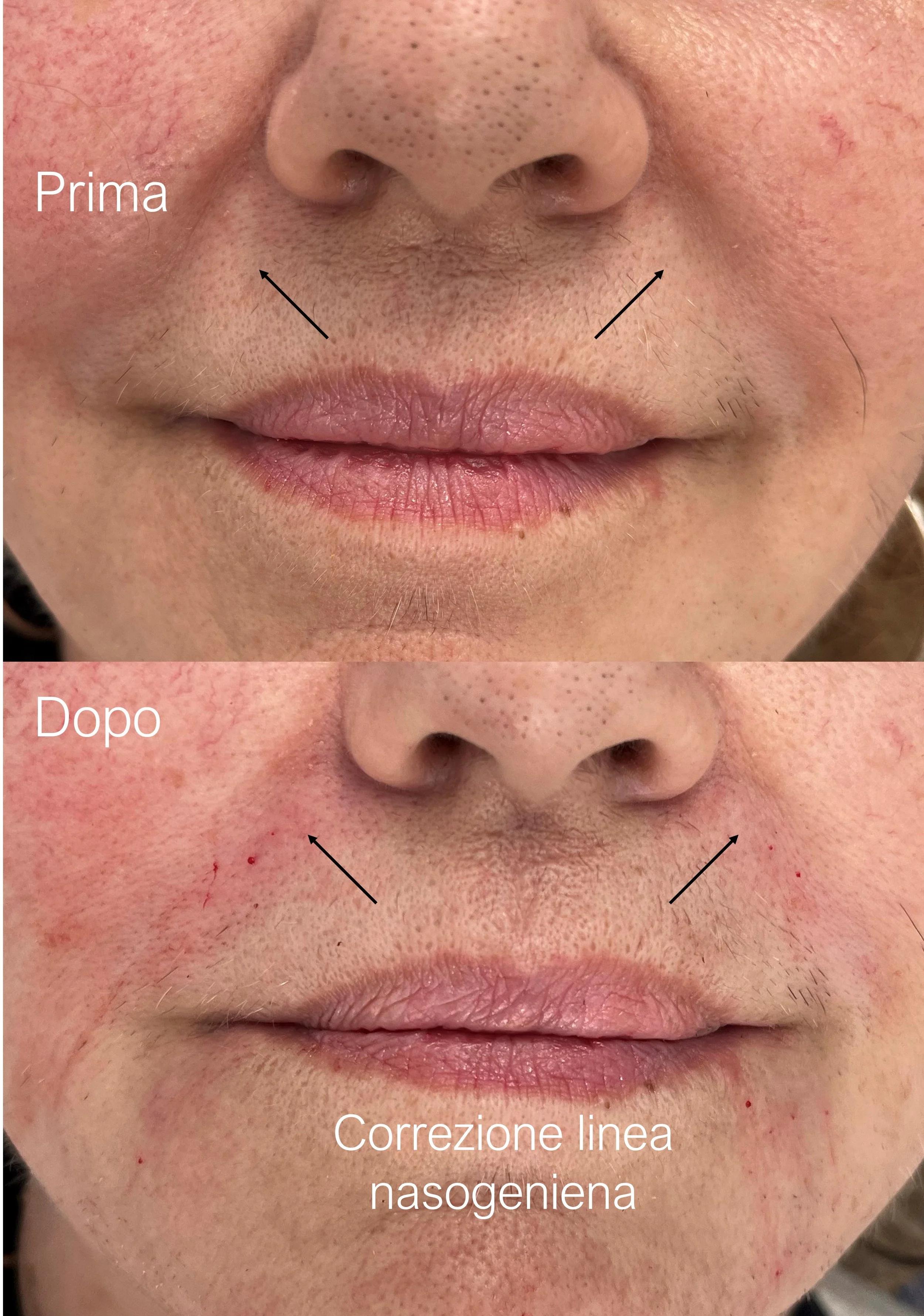 Collage prima e dopo correzione linea nasogeniena con filler, trattamento estetico naturale con la Dott.ssa Giulia Rubini tra Romagna e Marche.