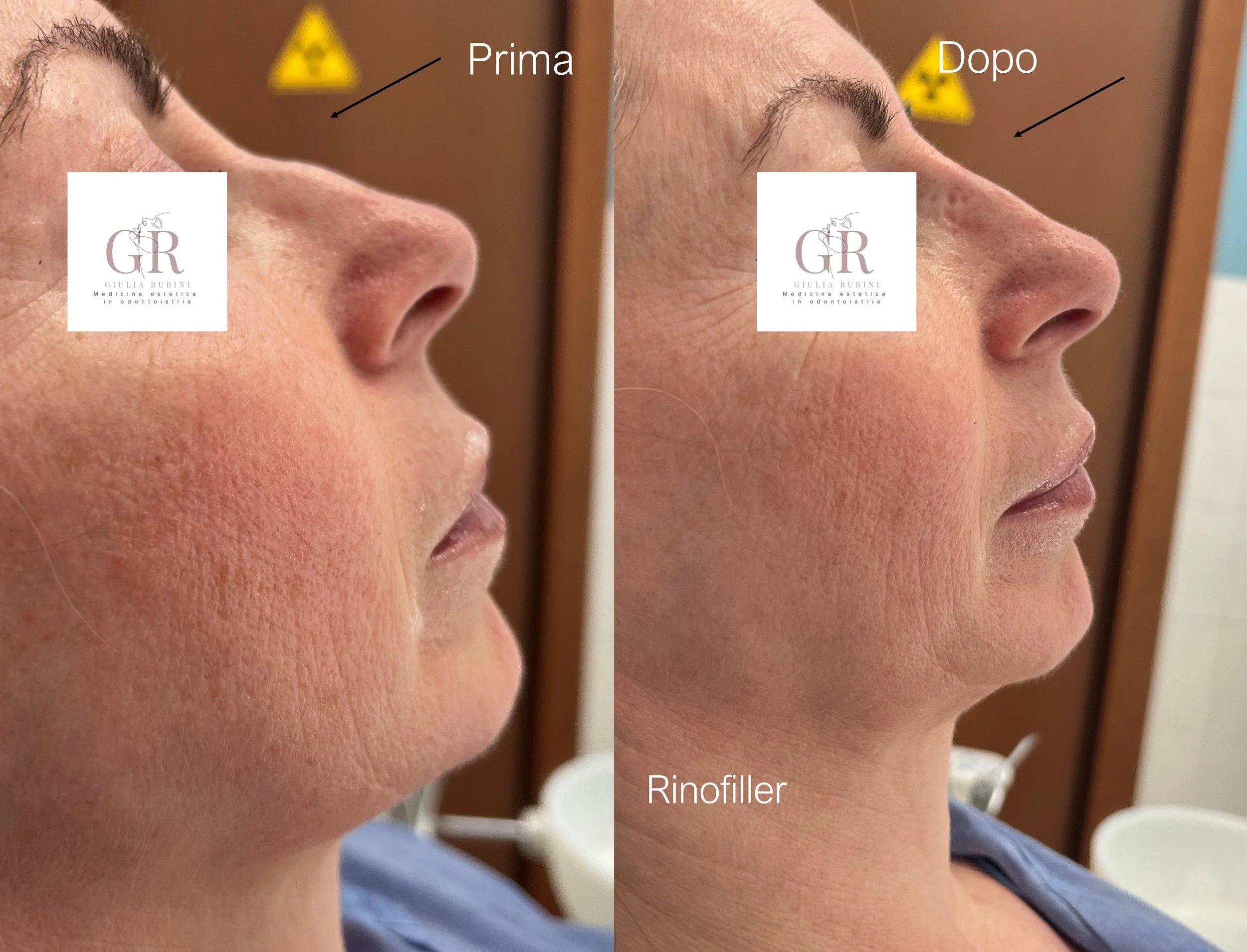 Collage prima e dopo trattamento di rinofiller con la Dott.ssa Giulia Rubini, naso armonioso e naturale a Rimini e Romagna.