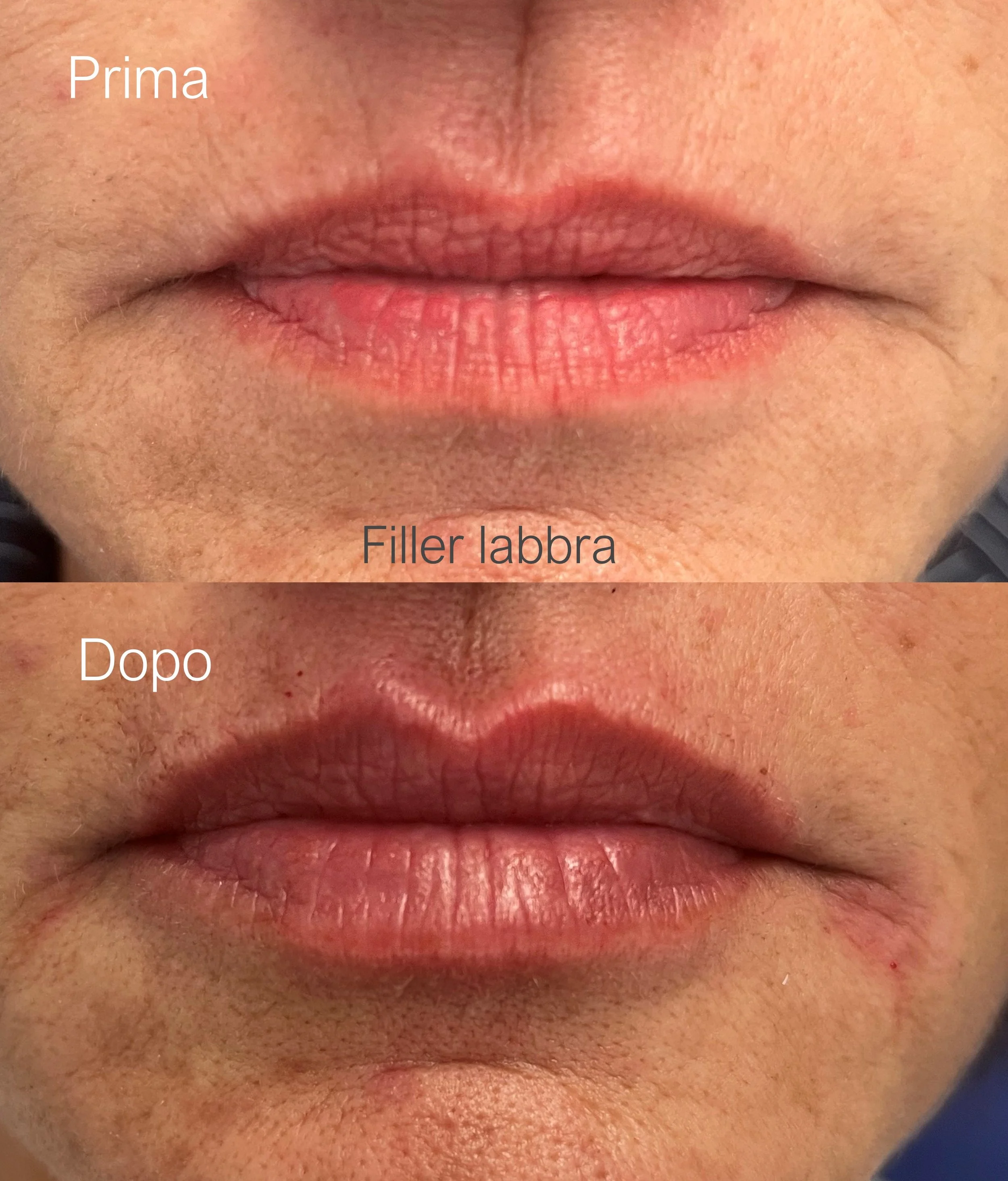 Prima e dopo filler labbra viso armonioso e naturale, trattamento estetico con la Dott.ssa Giulia Rubini in Romagna