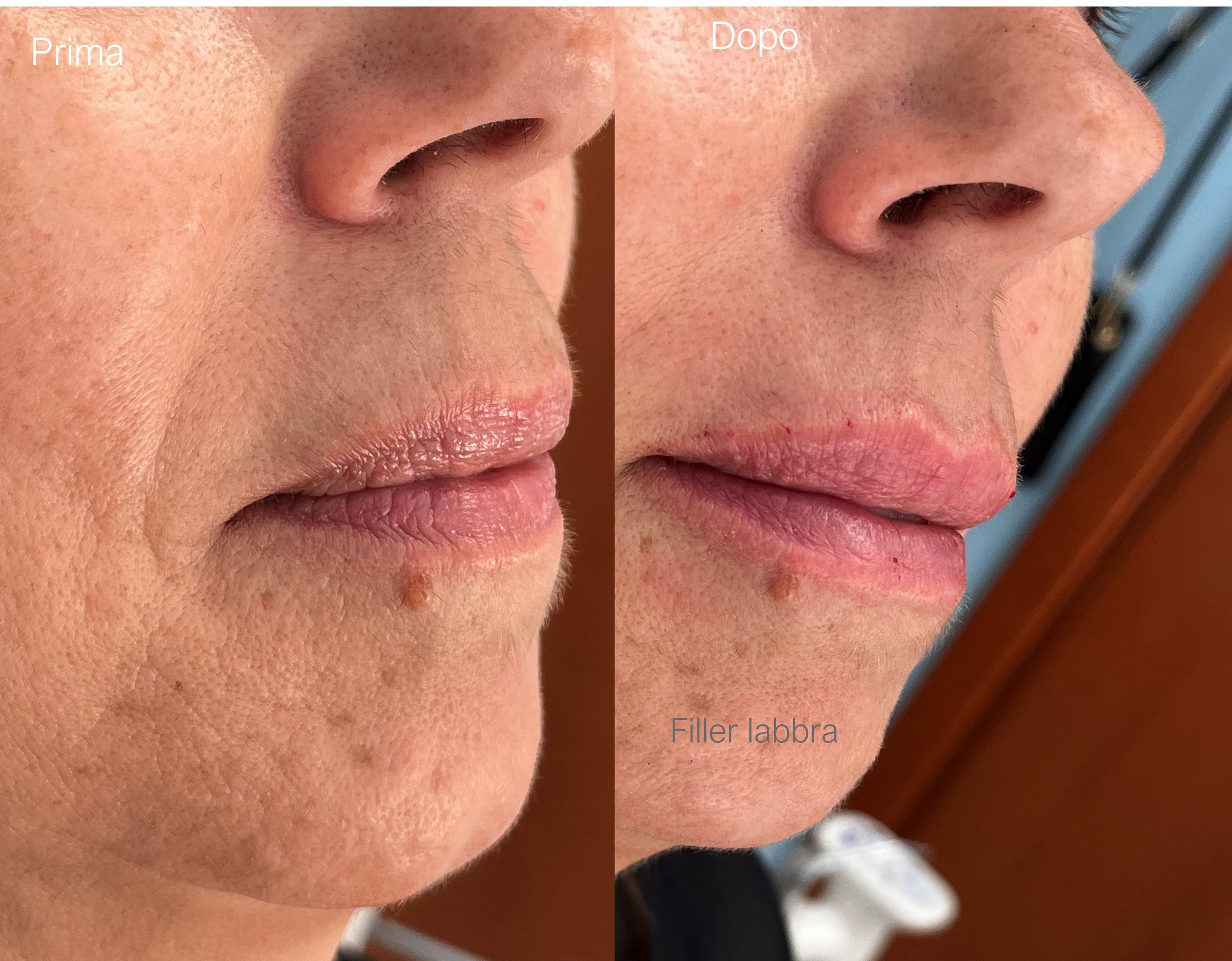 Immagine divisa in due parti, mostra un primo piano del viso di una donna con la bocca chiusa. La parte sinistra è etichettata "Prima" e mostra le labbra naturali, mentre la parte destra, etichettata "Dopo", mostra le labbra con un filler, con alcune piccole tracce di sangue sui bordi.