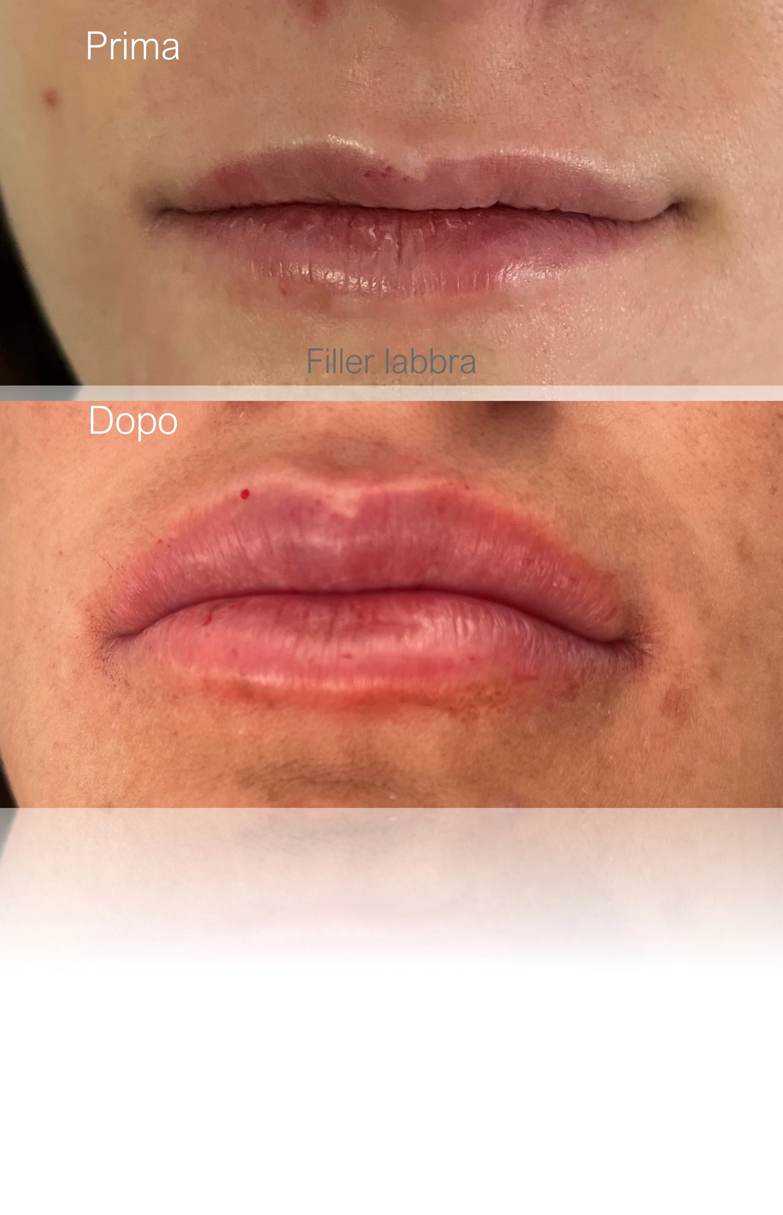 Prima e dopo filler labbra viso armonioso e naturale, trattamento estetico con la Dott.ssa Giulia Rubini in Romagna