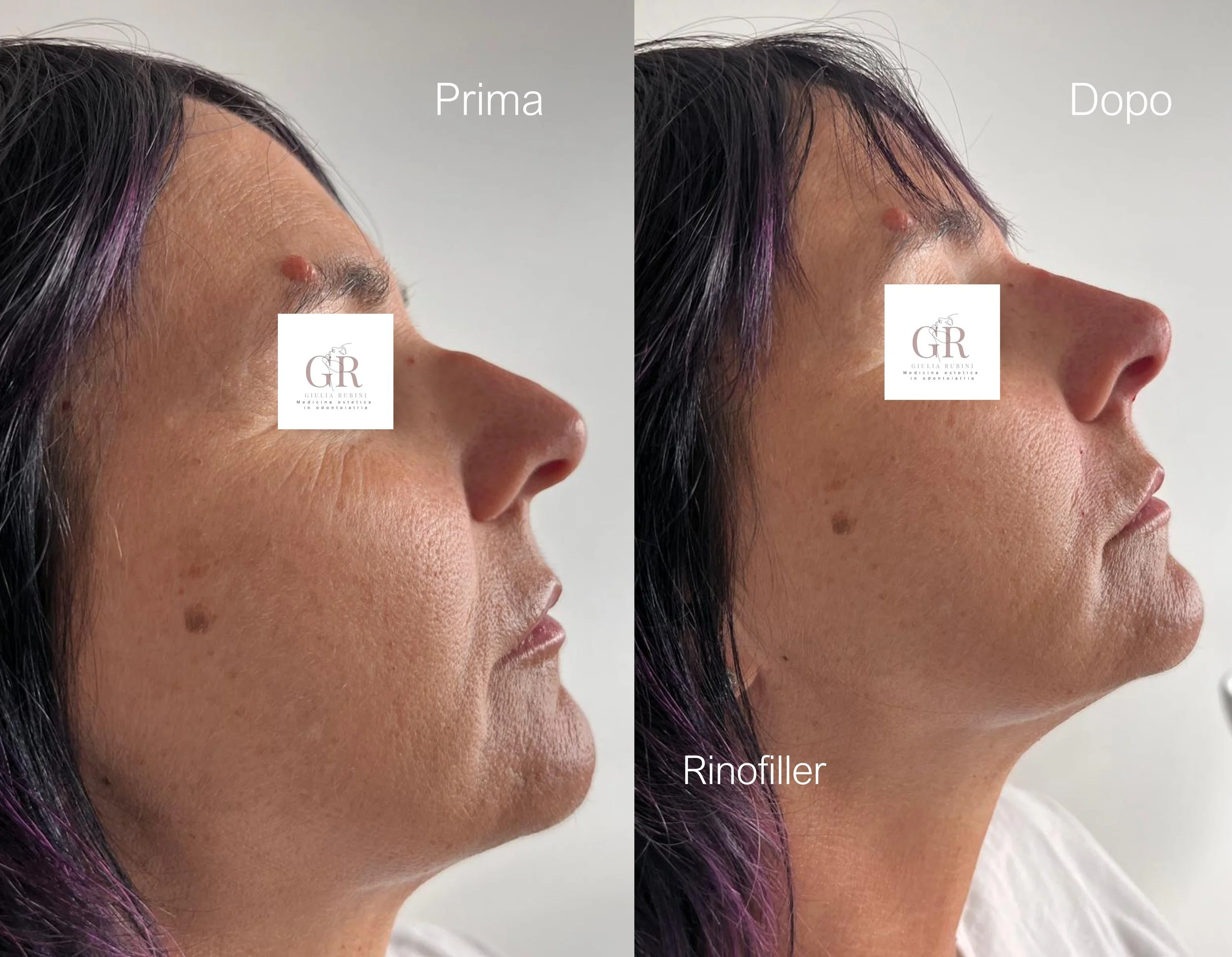 Rinofiller per correggere irregolarità del naso, migliorare il profilo e armonizzare i lineamenti in modo naturale – Dott.ssa Giulia Rubini, medicina estetica Romagna Marche