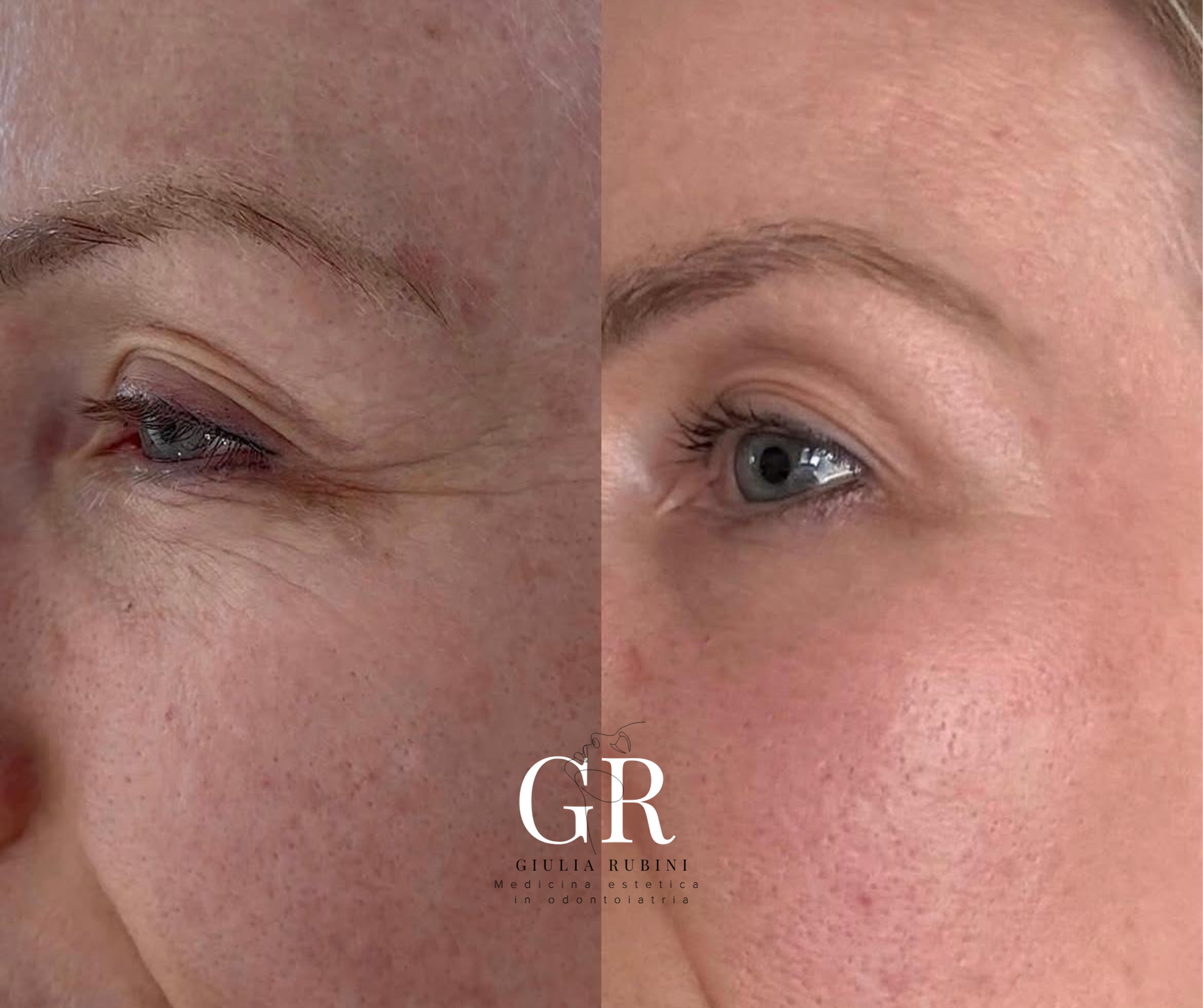 Immagine di un prima e dopo di un trattamento estetico al viso con tecnologia Air Plasma che mostra miglioramenti visibili nella pelle e nella riduzione delle rughe, effettuato dalla dott.ssa Giulia Rubini a Rimini.