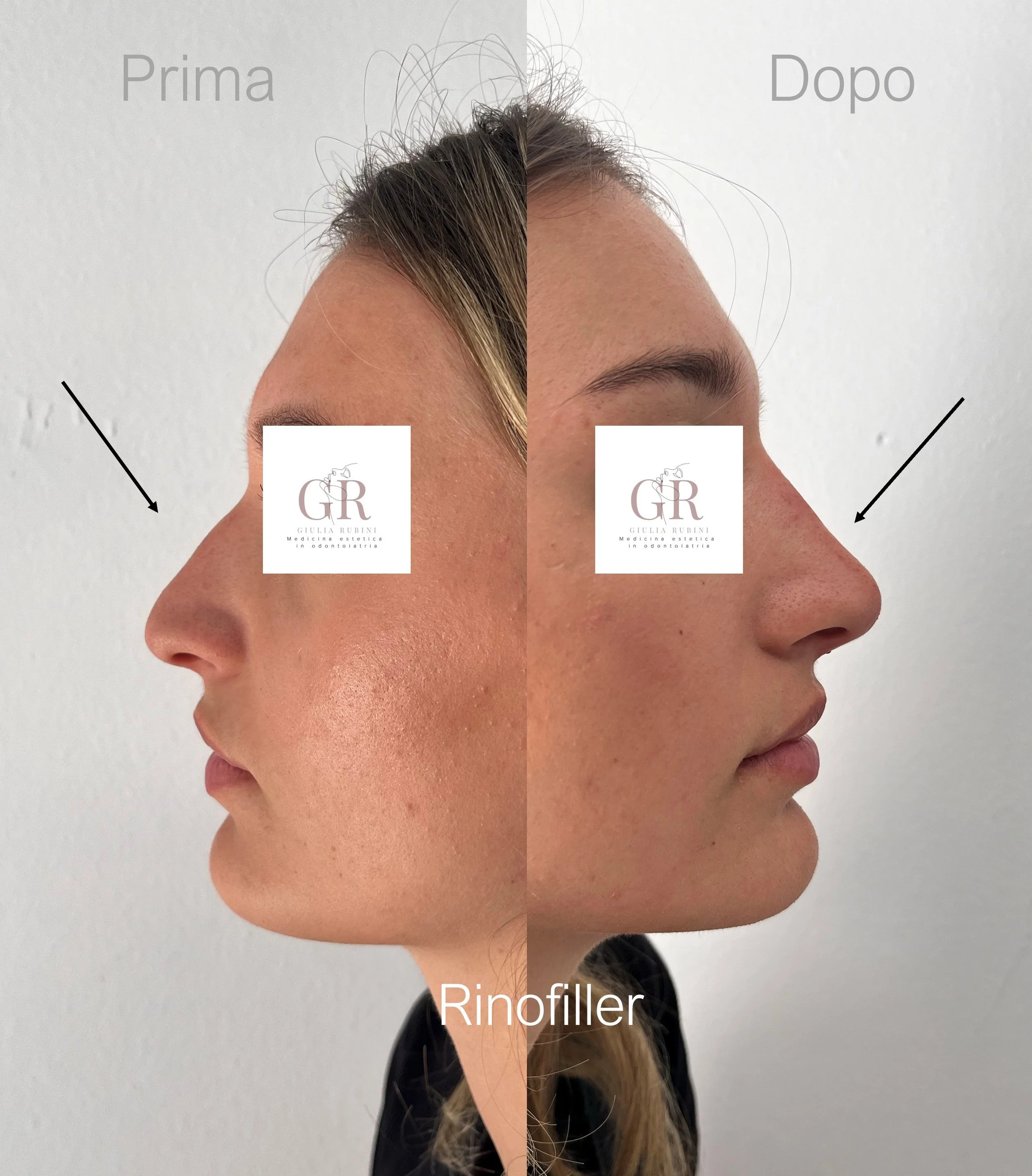 Rinofiller per correggere irregolarità del naso, migliorare il profilo e armonizzare i lineamenti in modo naturale – Dott.ssa Giulia Rubini, medicina estetica Romagna Marche