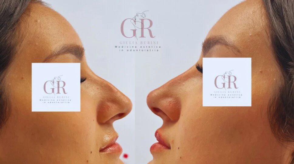 Immagine del prima e dopo di un trattamento di medicina estetica di una donna con dei filler viso per l'armonizzazione del profilo.