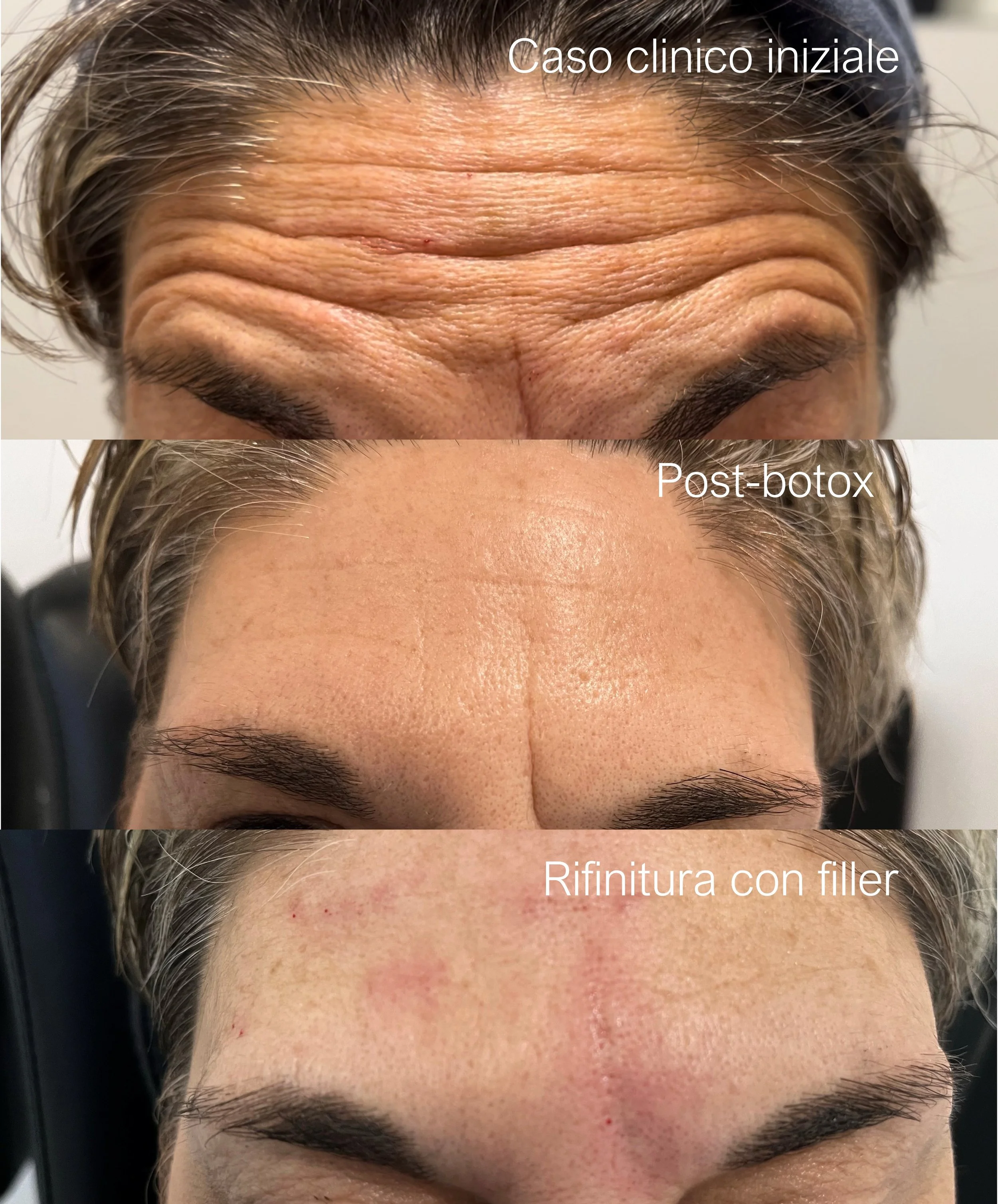 Serie di tre foto che mostrano un prima e dopo di un trattamento facciale: la prima immagine mostra fronte con rughe e linee di invecchiamento, la seconda immagine mostra una pelle più liscia e levigata dopo un trattamento al botox, la terza immagine mostra ulteriori miglioramenti con una rifinitura con filler.
