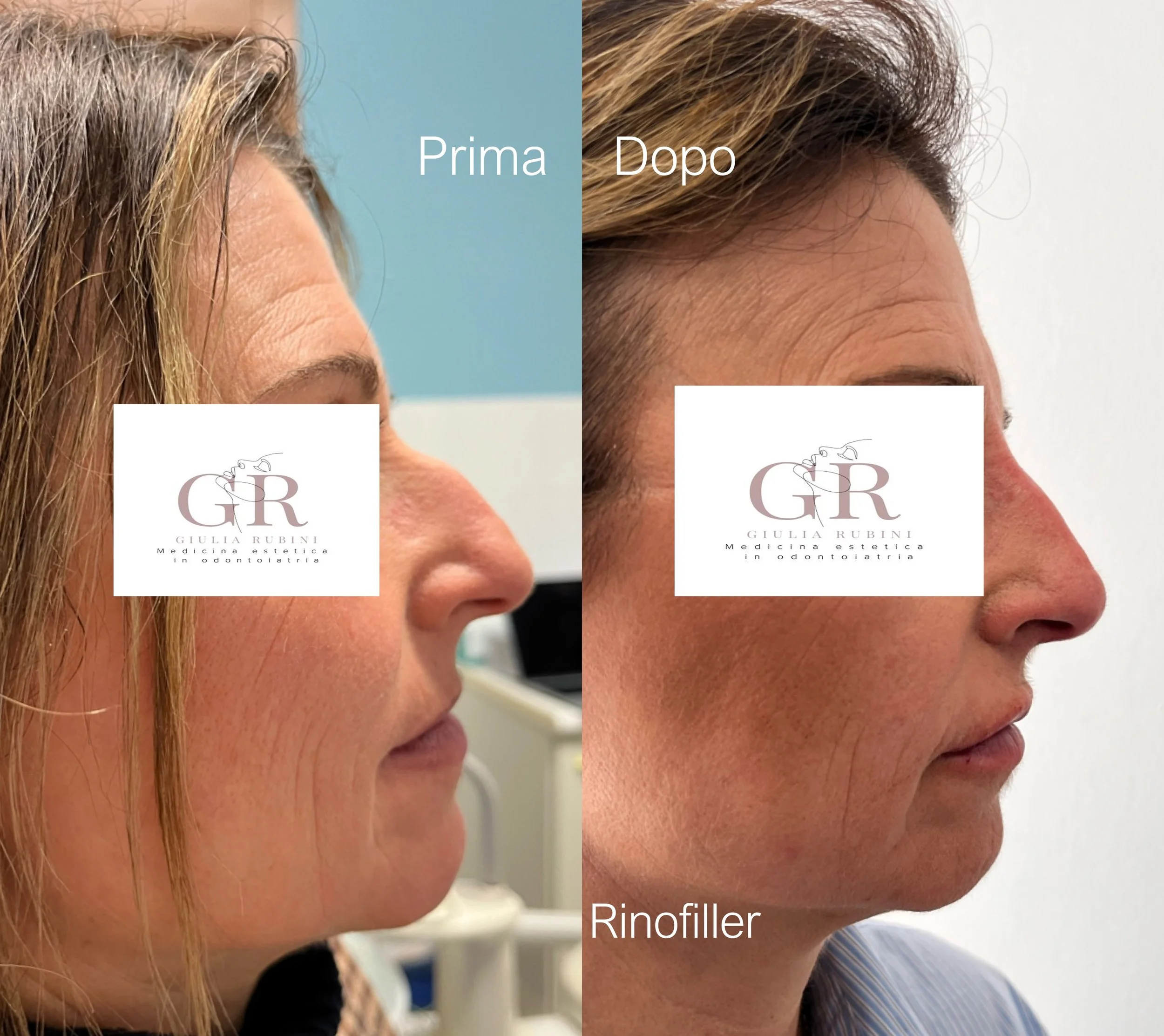 Rinofiller per correggere irregolarità del naso, migliorare il profilo e armonizzare i lineamenti in modo naturale – Dott.ssa Giulia Rubini, medicina estetica Romagna Marche