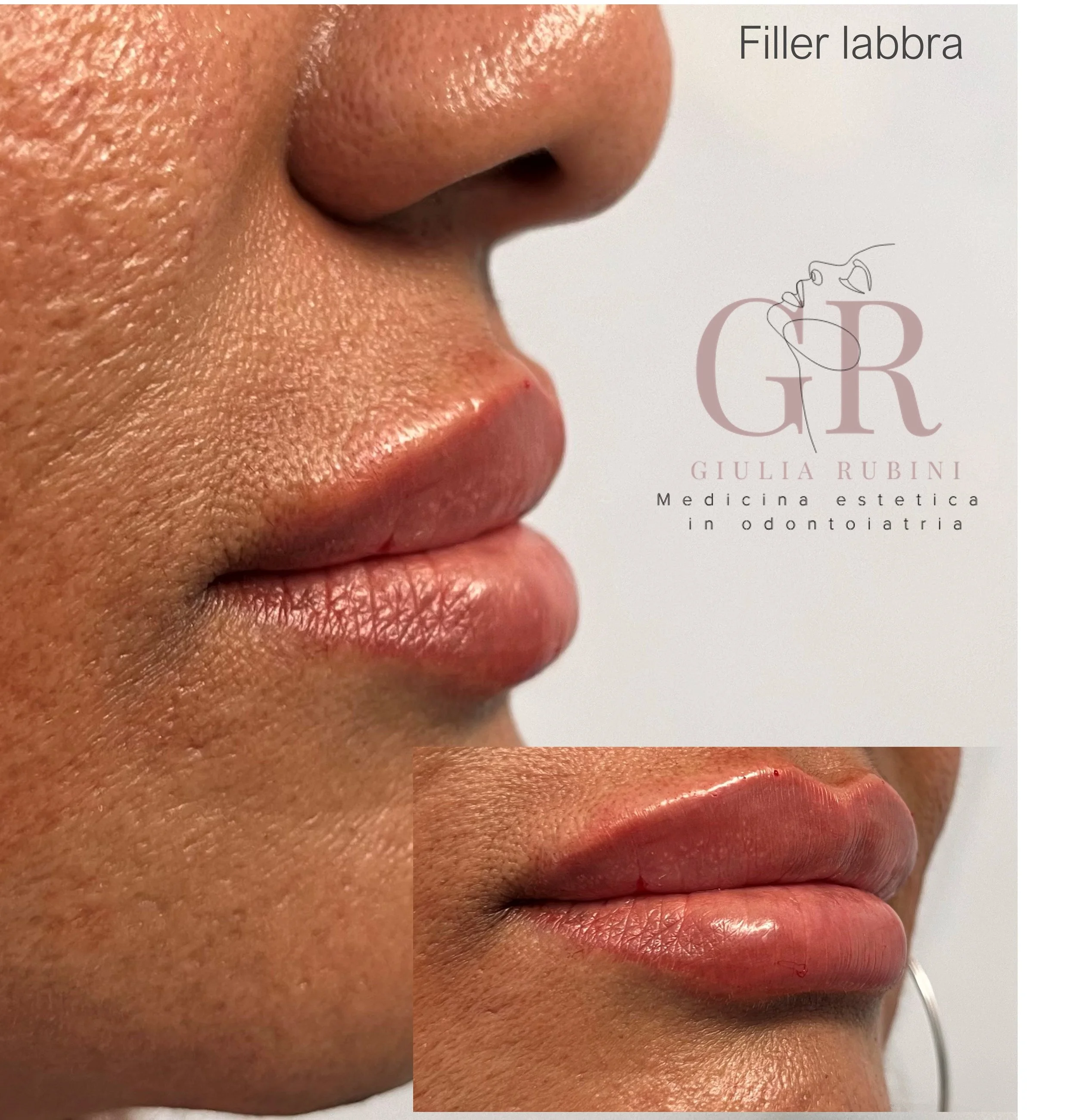 Prima e dopo filler labbra viso armonioso e naturale, trattamento estetico con la Dott.ssa Giulia Rubini in Romagna