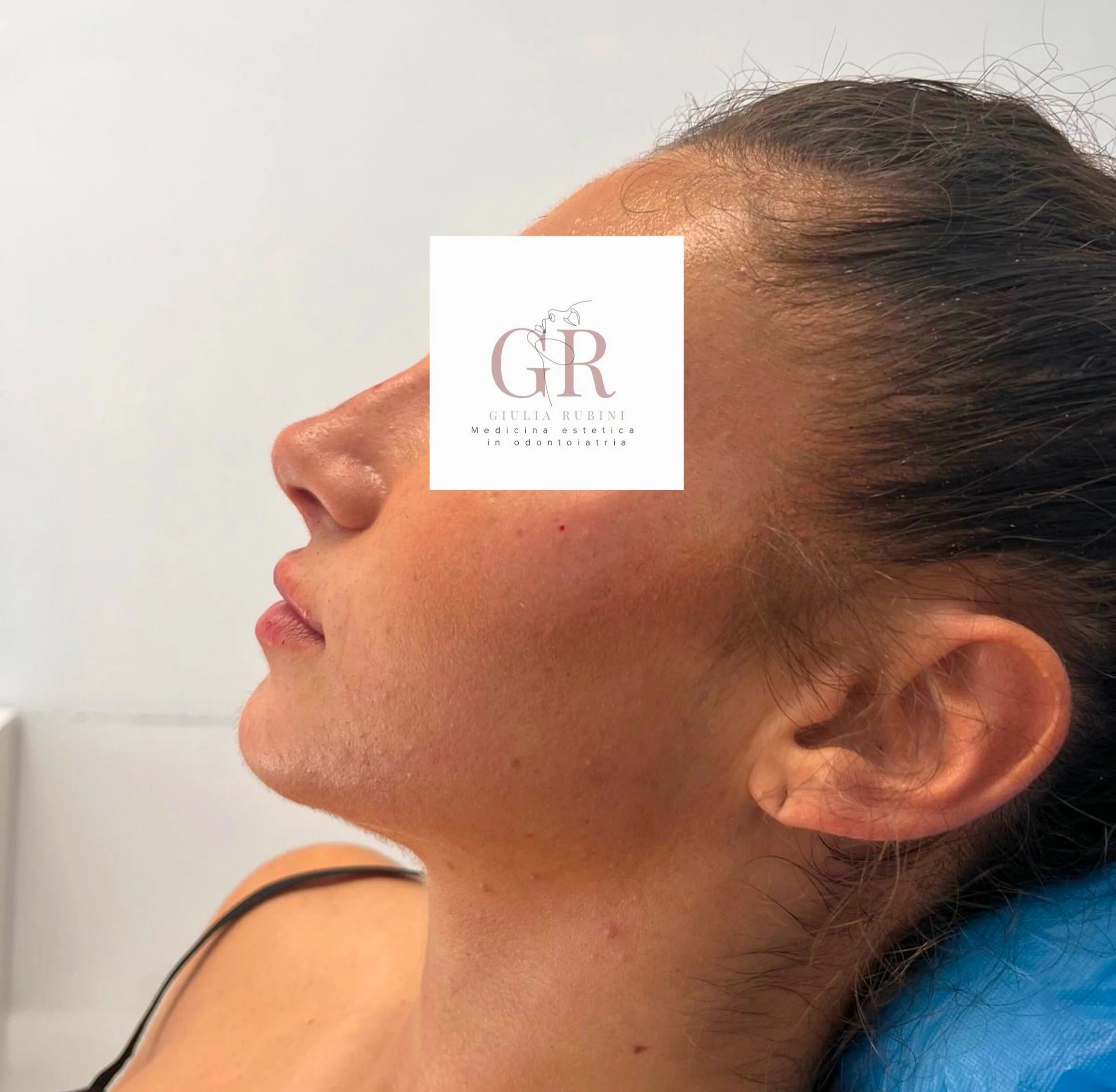 Profilo di una donna che ha effettuato un trattamento di filler labbra e rinofiller dalla dott.ssa Giulia Rubini.