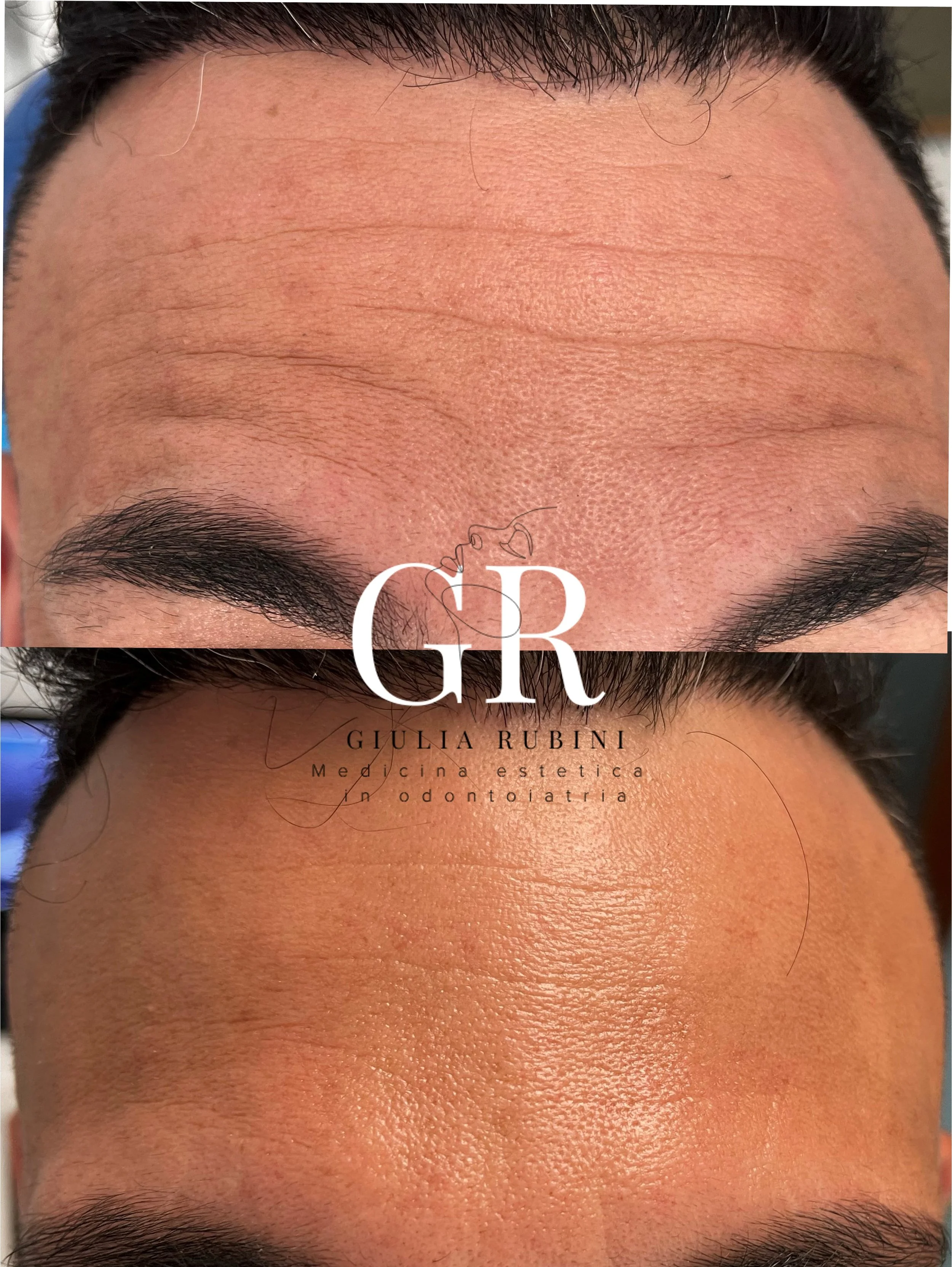 Collage prima e dopo botox fronte con la Dott.ssa Giulia Rubini, viso rilassato e naturale a Morciano