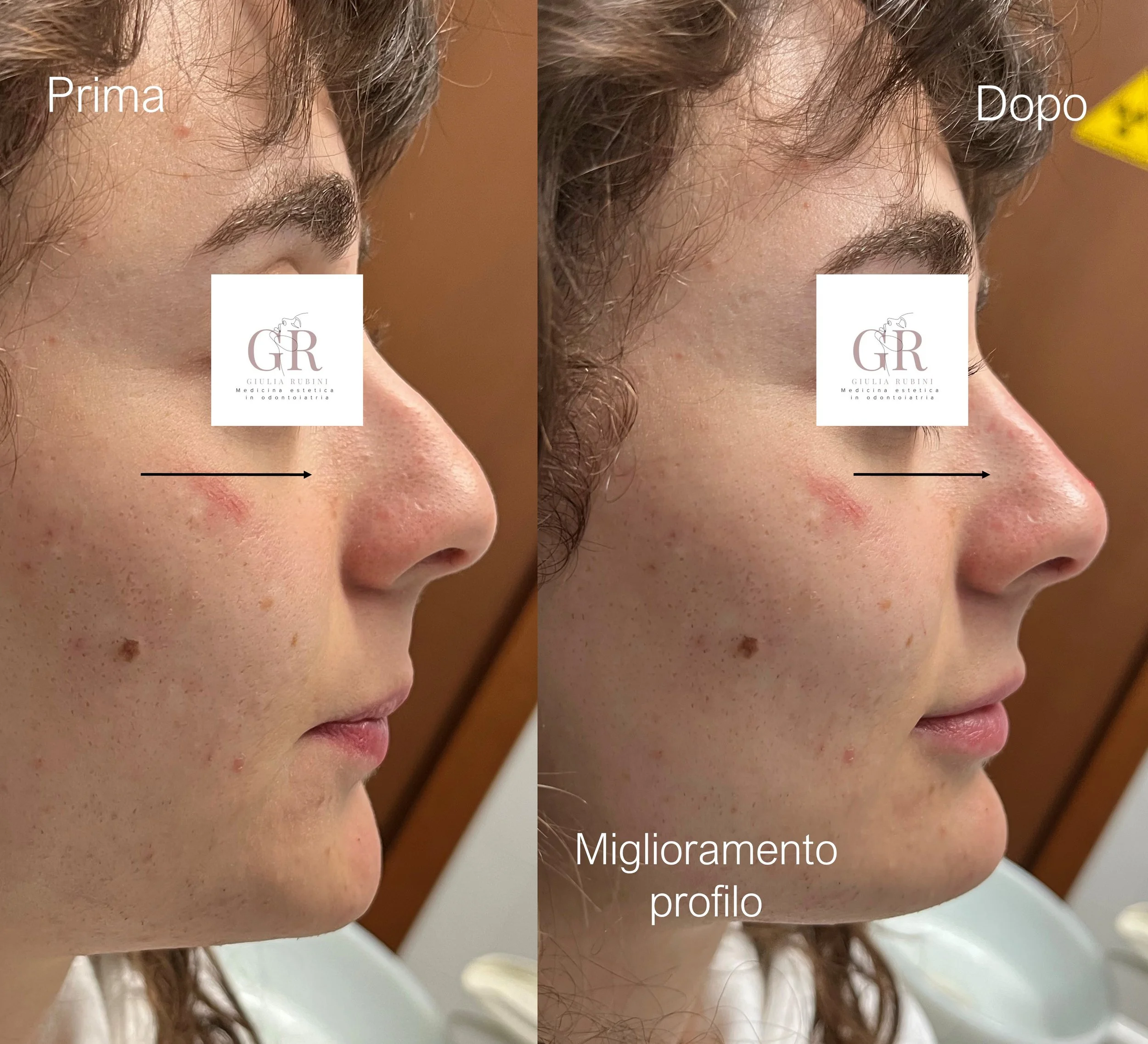 Prima e dopo trattamento estetico visibile sul profilo di una donna, evidenziando miglioramento del profilo facciale attraverso due immagini affiancate.