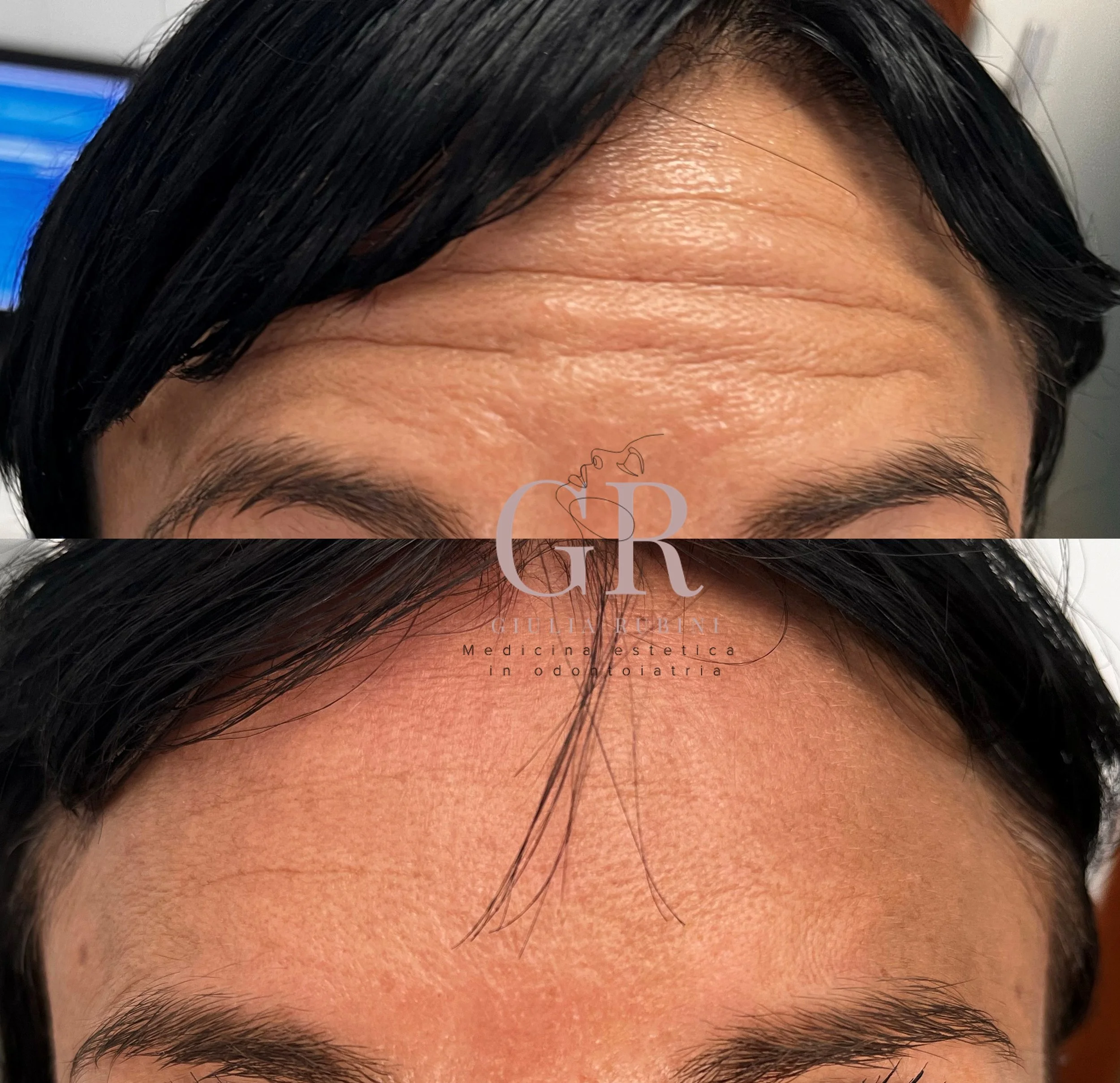 Collage prima e dopo botox fronte con la Dott.ssa Giulia Rubini, viso rilassato e naturale a Rimini