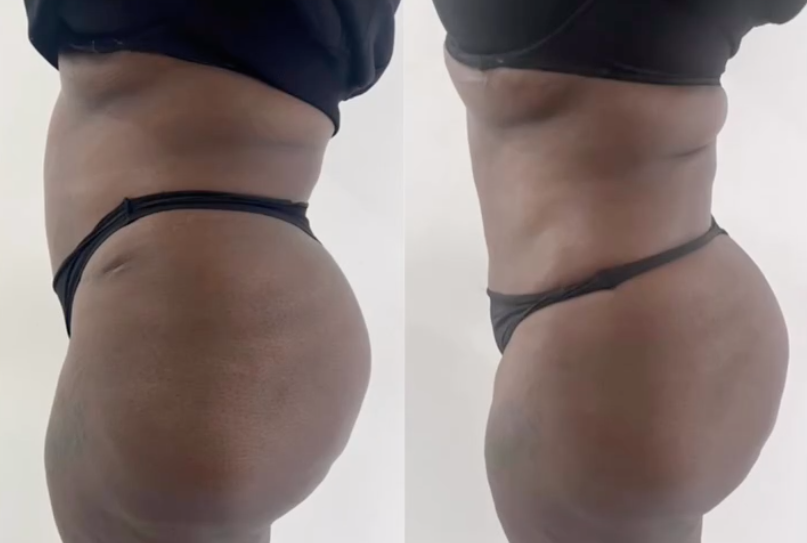 Comparison of a woman's midsection before and after massage technique, showing reduced body fat and slimmer waistline in the second image.