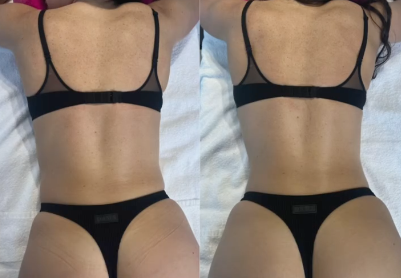 Side-by-side comparison of a woman's back and buttocks showing improved body shape after a massage transformation.