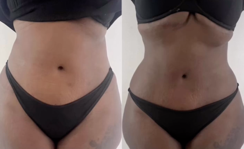 Comparison of a woman's midsection before and after a lymphatic drainage massage, body transformation, showing a slimmer waist on the right.