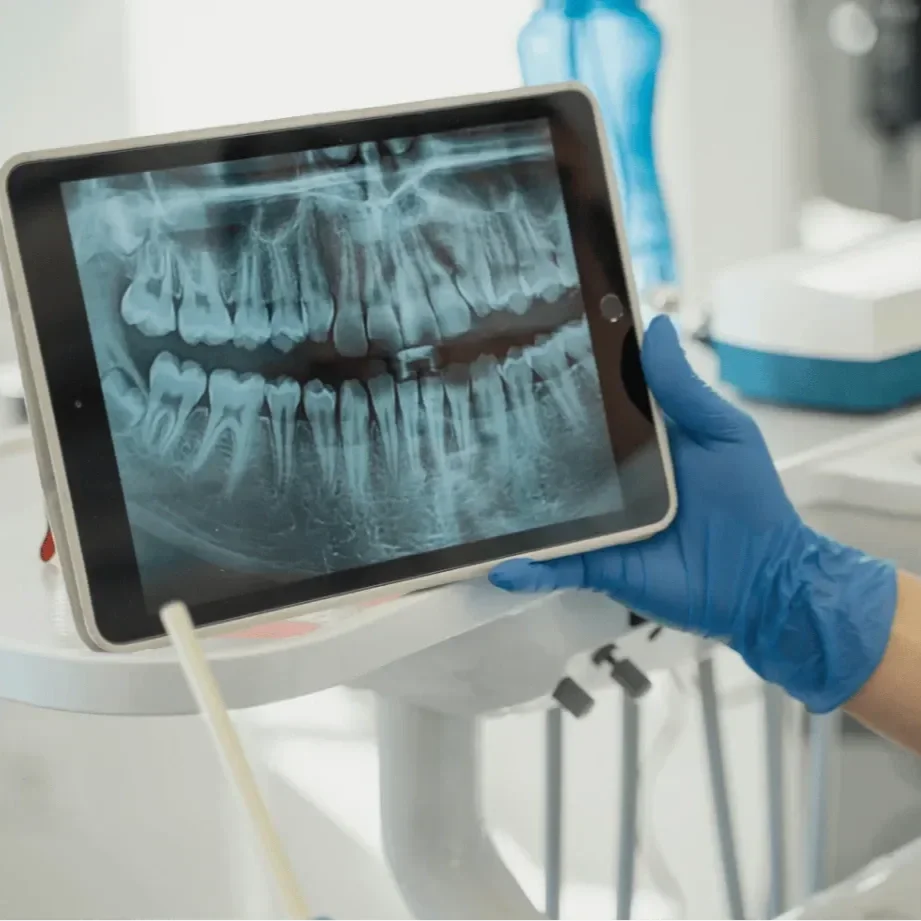 A digital dental X-ray displayed on a tablet held by a person wearing a blue glove, showing the upper and lower teeth and jaw.