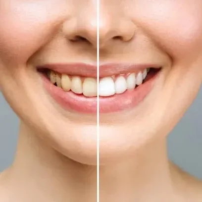 Close-up of a person's smile showing a before-and-after comparison of teeth, with the right side displaying whiter, straighter teeth.