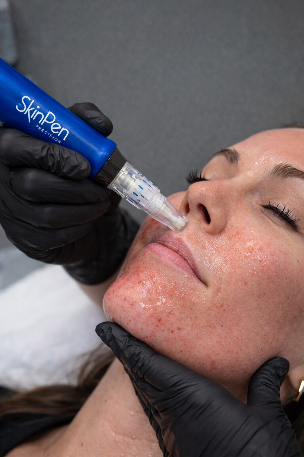 A person receives a facial treatment with a skincare device called SkinPen, while lying down with eyes closed, in a skincare clinic.