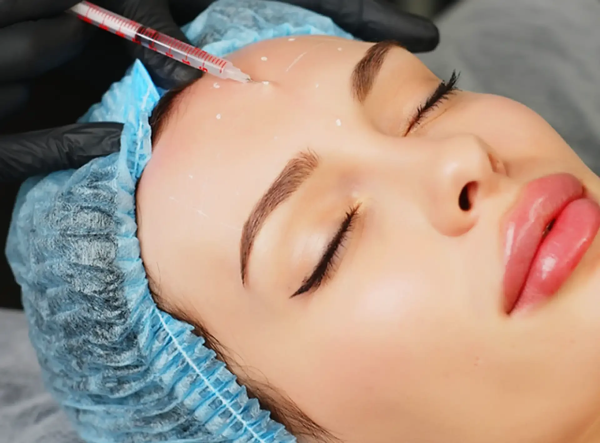 A woman receiving a cosmetic procedure, with a syringe injecting a substance into her forehead while lying down with her eyes closed, wearing a blue hair cover and black gloves.