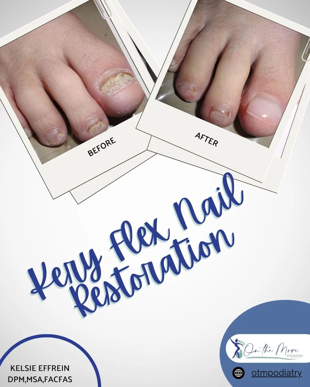 Before (Left): The toenail appears damaged, discolored, and brittle, which is common with fungal infections or trauma.
After (Right): Following the KeryFlex treatment, the nail looks healthy, smooth, and natural, restoring both appearance and confide