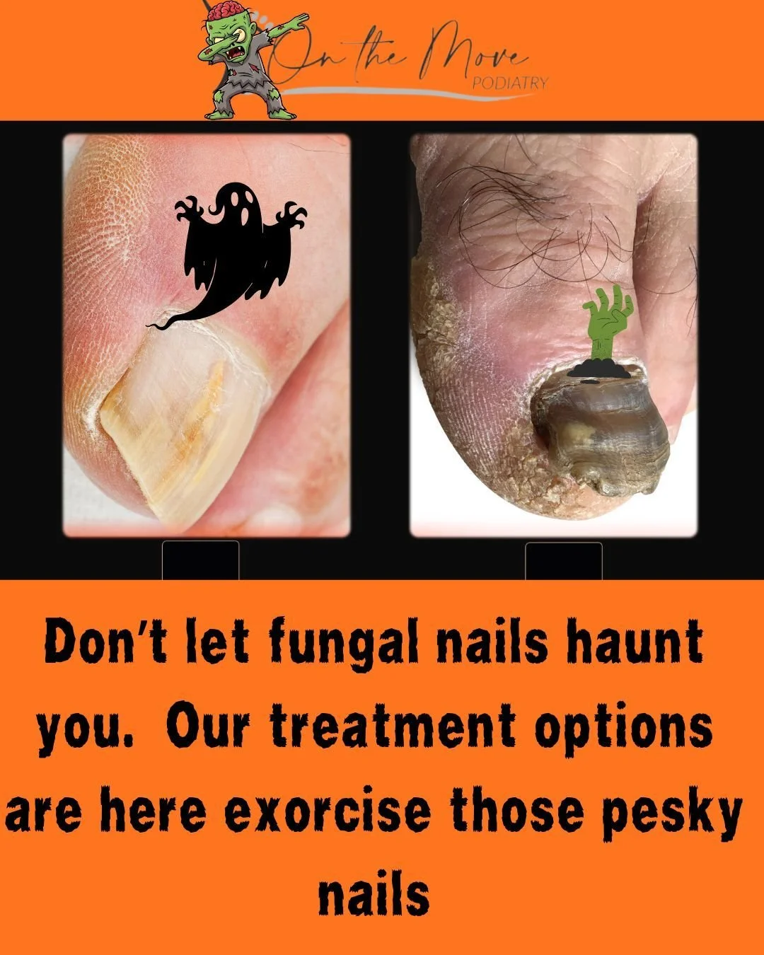 Don't let scary nails keep you from enjoying Halloween.  At On the Move Podiatry we have treatment options to take nails from FUNGAL TO FABULOUS! Book appointment today to learn more. https://www.otmpodiatry.com/ #footandankle #nails #halloween #phoe