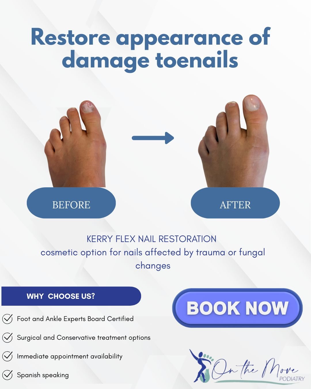 Discolored or damaged toenails can be frustrating. KeryFlex Nail Restoration is a cosmetic option designed to improve the appearance of nails. The restoration allows the natural nail to grow underneath and does not interfere with medical treatment pl