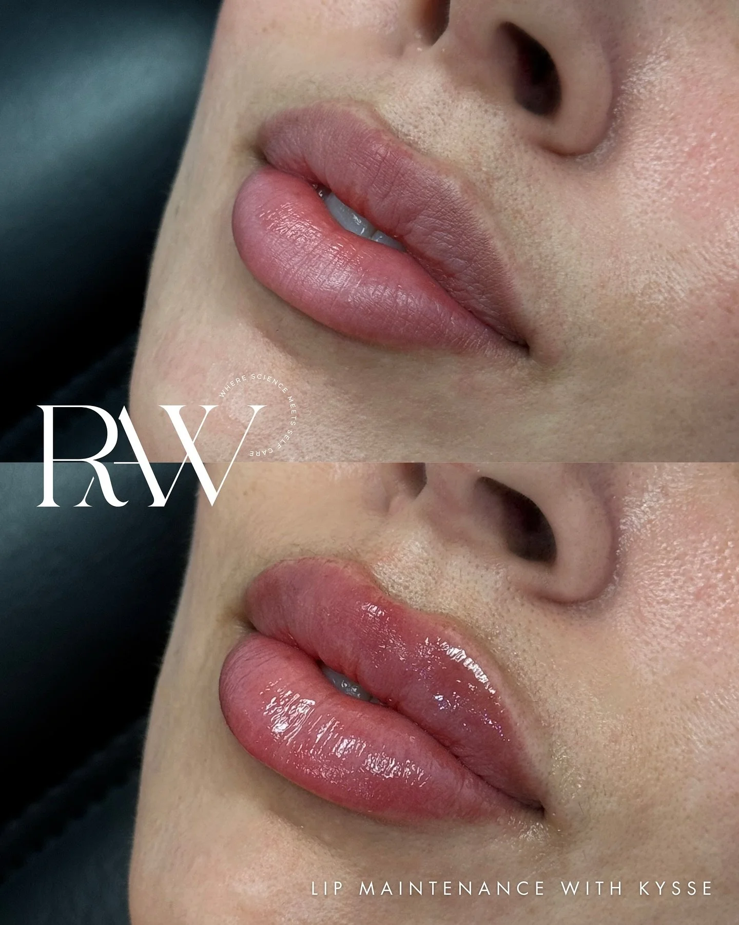 Precision. Balance. Volume. Redefined.
This is lip filler, the RAW way. 
#RefinedResults #RAWLips

Is this the sign you were needing to book your appointment?! 👀✨

💉 Refined Aesthetics &amp; Wellness in San Antonio, Tx
Don&rsquo;t forget &mdash; $5