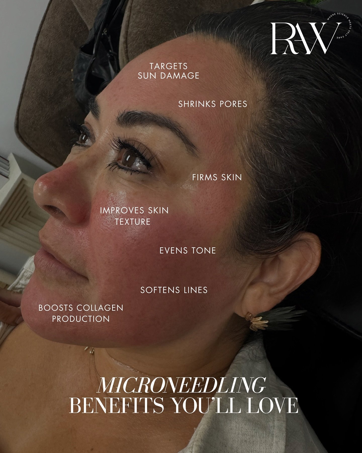 Microneedling is one of those treatments that delivers every time. 💫
Smoother texture, tighter pores, softer lines, clearer skin &mdash; it all starts with controlled collagen stimulation.

Add PDGF and it becomes next-level:
&bull; Faster healing
&