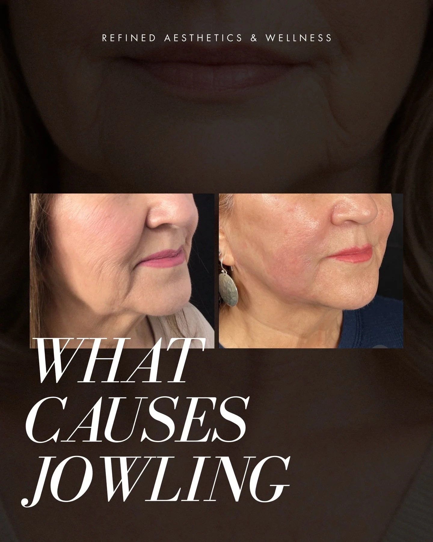 Jowling isn&rsquo;t just &ldquo;loose skin.&rdquo; 👇
It&rsquo;s the result of changes in bone support, fat placement, ligaments, skin quality, and muscle movement over time.

A personalized approach starts with understanding your structure.

📍 Refi