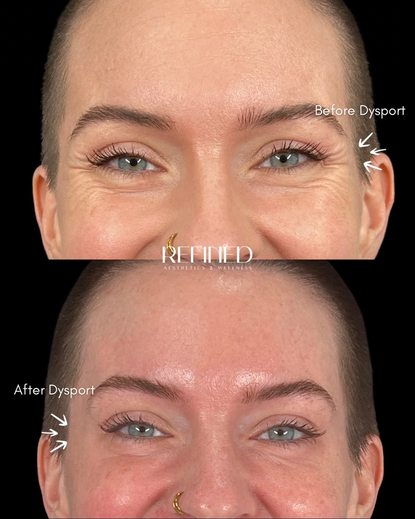 Dysport isn&rsquo;t about changing your face, it&rsquo;s about refining it. 
Before &amp; after results designed to smooth, soften, and still feel like you.

✨ Ready for subtle, refreshed results? Book your tox consultation today!

📍 Refined Aesthet