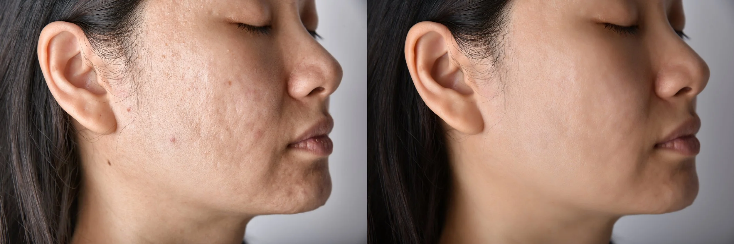 skin-problems-and-acne-scar-before-and-after-acne-2024-11-27-06-01-39-utc.jpg