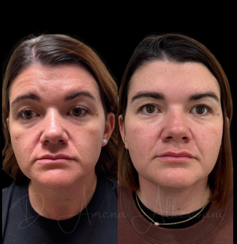 This is the result of a comprehensive treatment plan including hormonal balancing, skin health, and perfectly placed filler. 

We love a good overall transformation and this is where @kairosaestheticsandwellness leads in aesthetics and wellness. We p