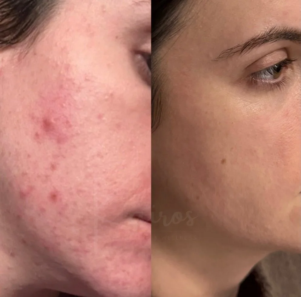 The power of Skin Accumax supplements, VI peels, the right products, and patient compliance 😍

Skin Accumax&trade; 

Contains vitamin
&bull; A, C, E and phytonutrients
&bull; Supports all areas of the body including back and shoulders
&bull; Clarifi