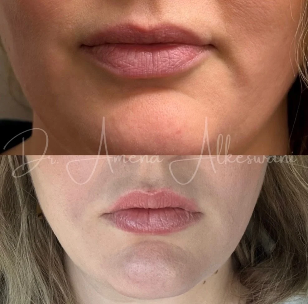 Not every lip treatment starts with the lips 💋 

This is why consultation matters.

This patient came in wanting lip filler, but after a full facial assessment, it was clear the concern wasn&rsquo;t just volume. Support around the mouth and chin had