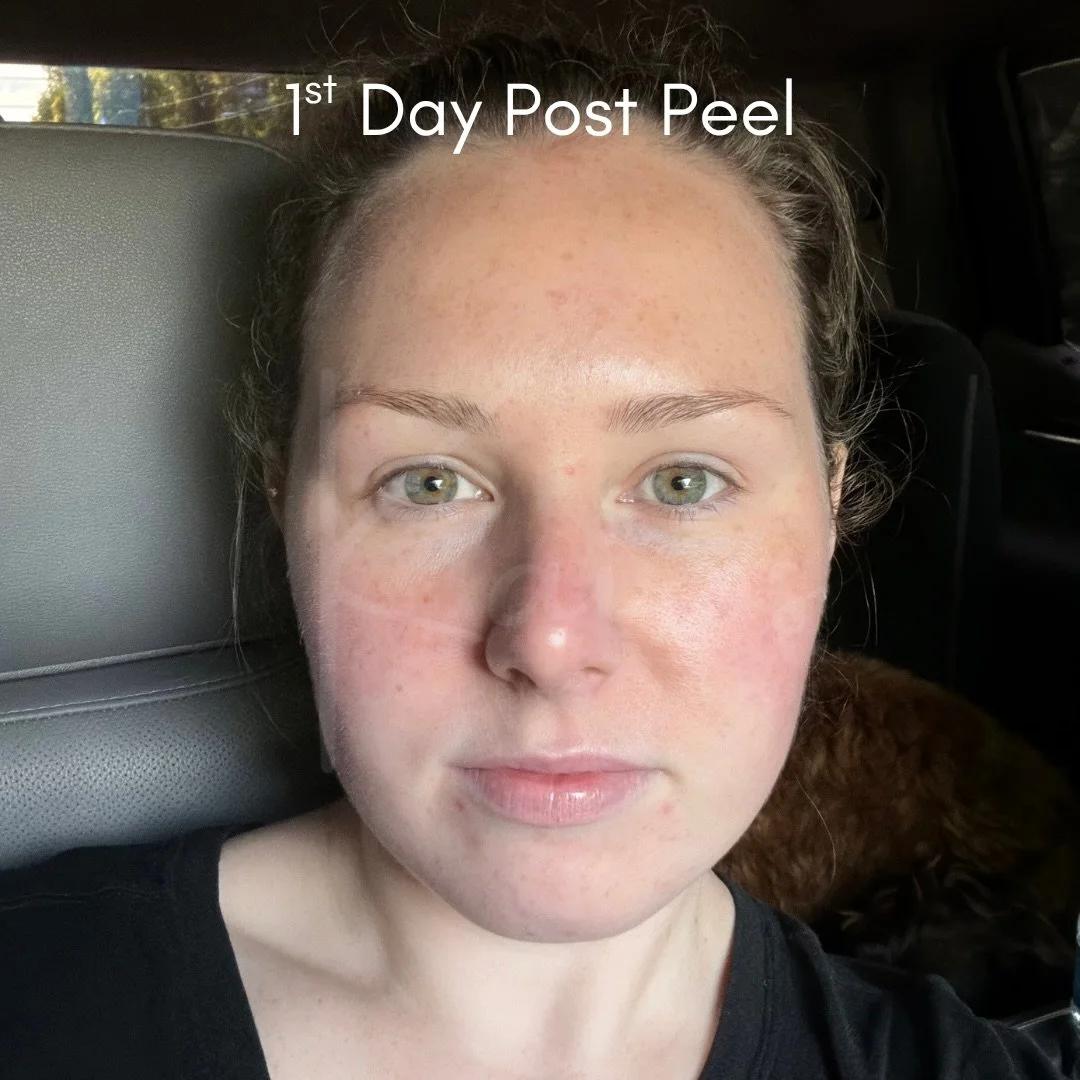 One week, one glow-up ✨

Anne Turner&rsquo;s journey with the VI Peel this past week is the perfect reminder that real skin transformation doesn&rsquo;t happen overnight, but it does happen with the right treatment and consistency.

From day 1 tightn