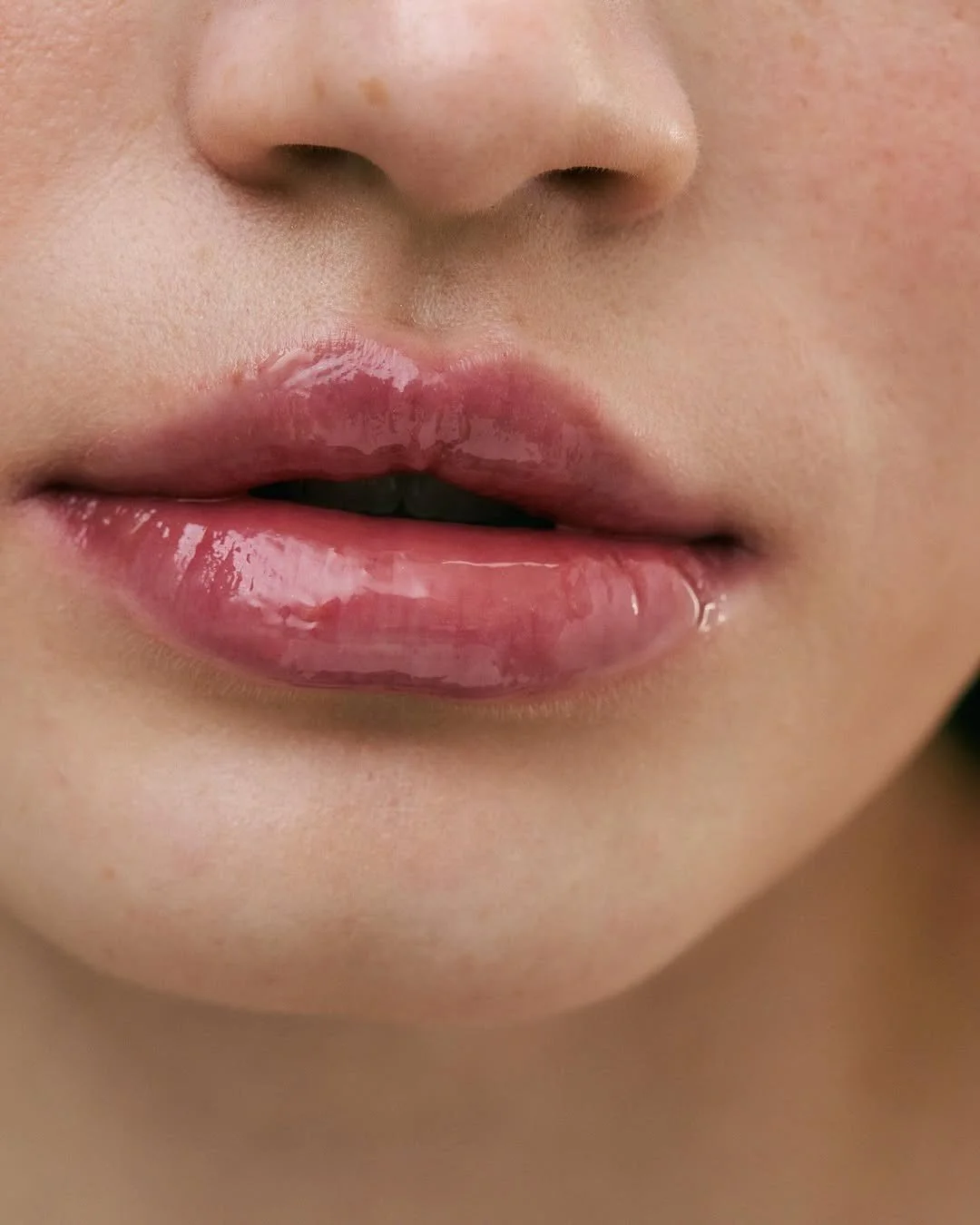 How to prepare for your dermal filler appointment?