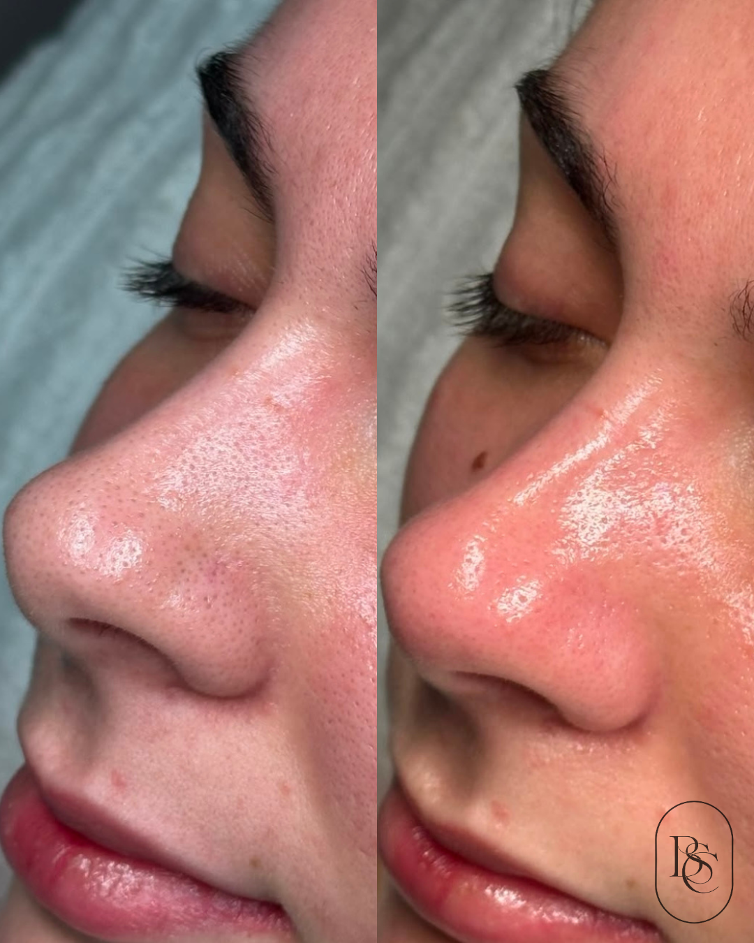 Side-by-side comparison of a person's face before and after skin treatment showing clearer and less congested pores on the nose.