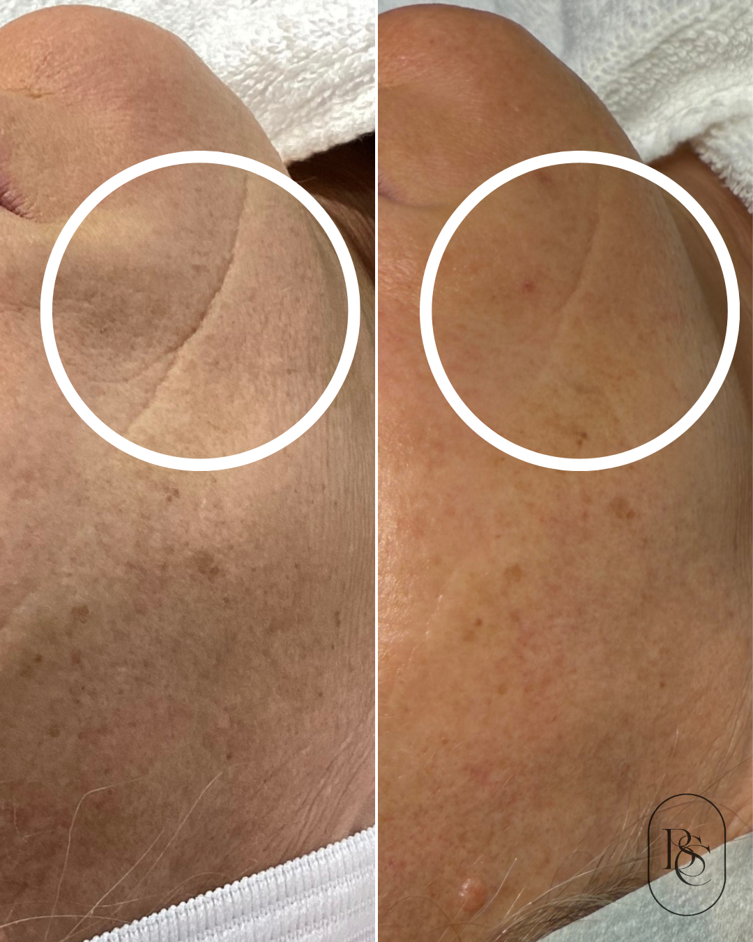 Side-by-side comparison of skin on a person's cheek before and after treatment, with visible improvement in skin texture and pigmentation.