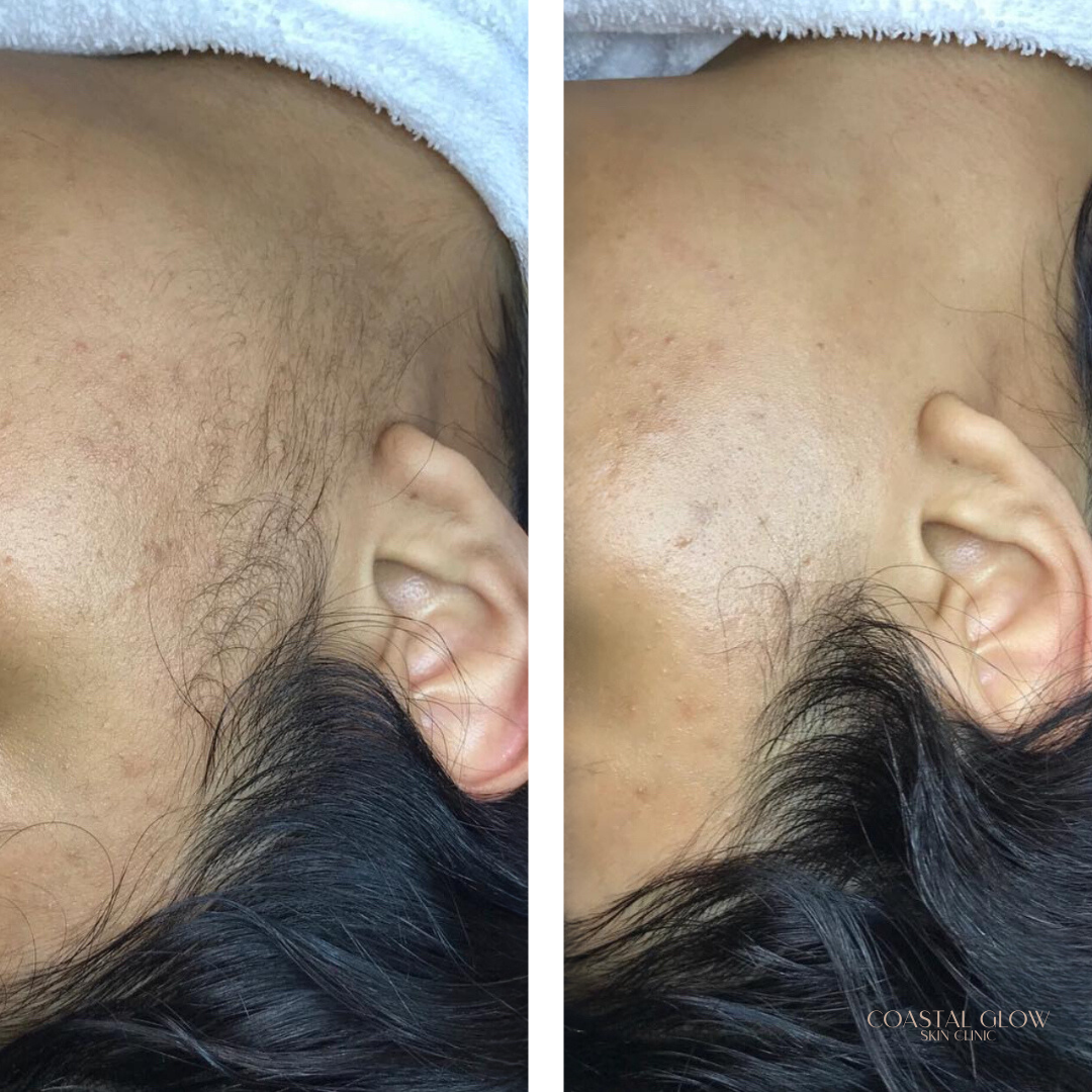 Dermaplaning BeforeAfter.png
