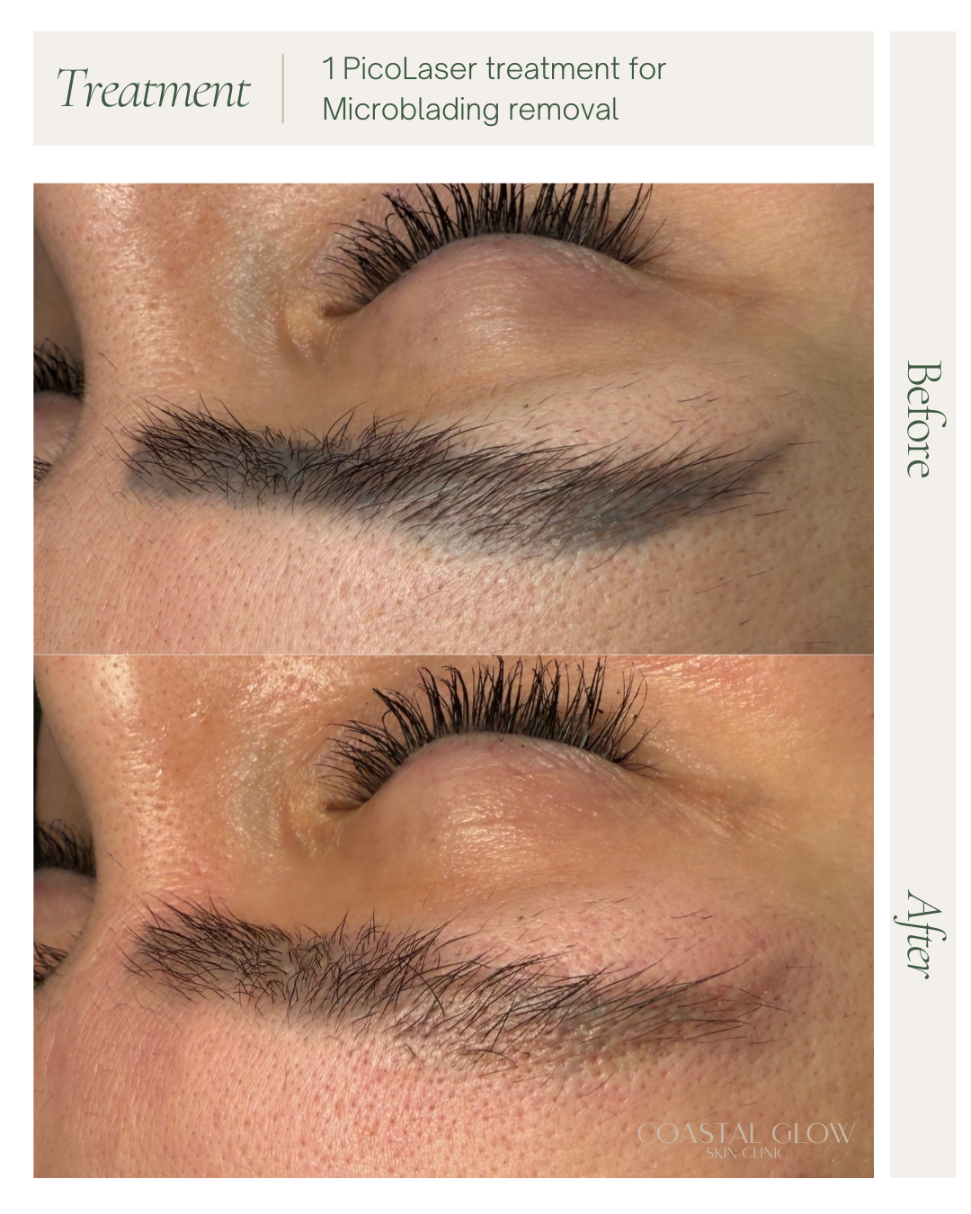Microblading BA.png