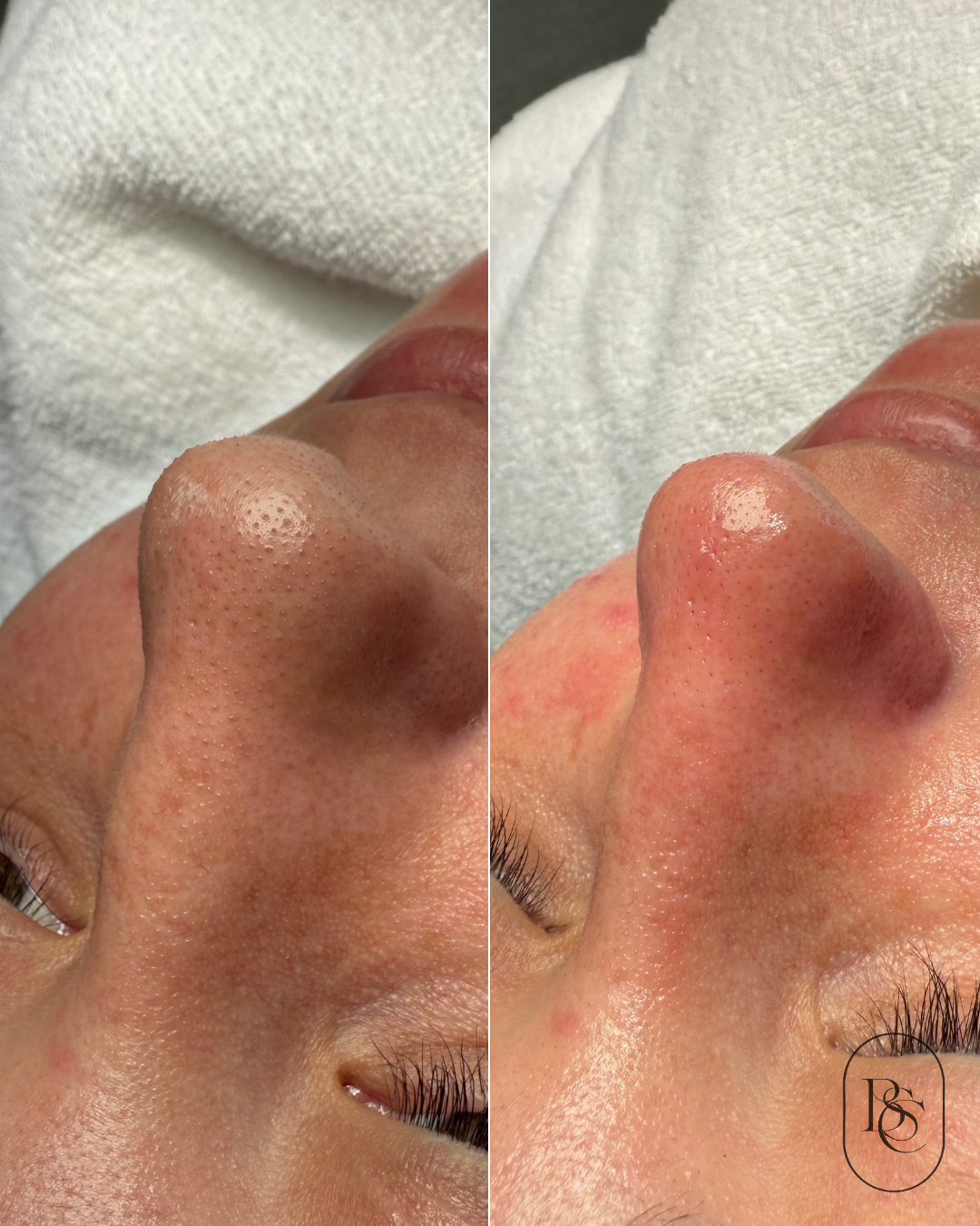Close-up comparison of a person's nose before and after skincare treatment, showing reduced pore size and smoother skin.
