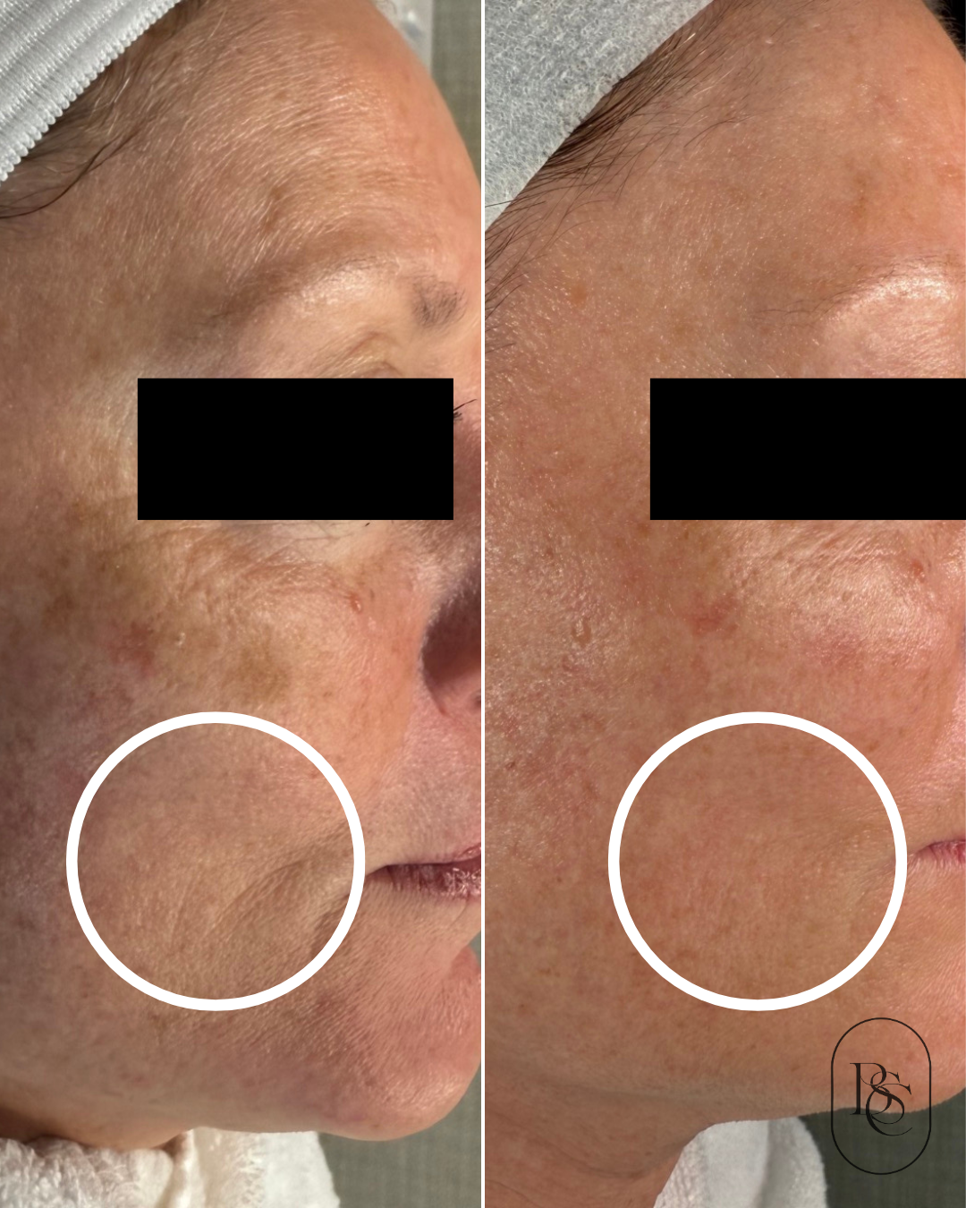 Side-by-side comparison of a person's face showing improvement in skin texture and appearance after treatment, with the left side showing rougher skin and the right side showing smoother skin.