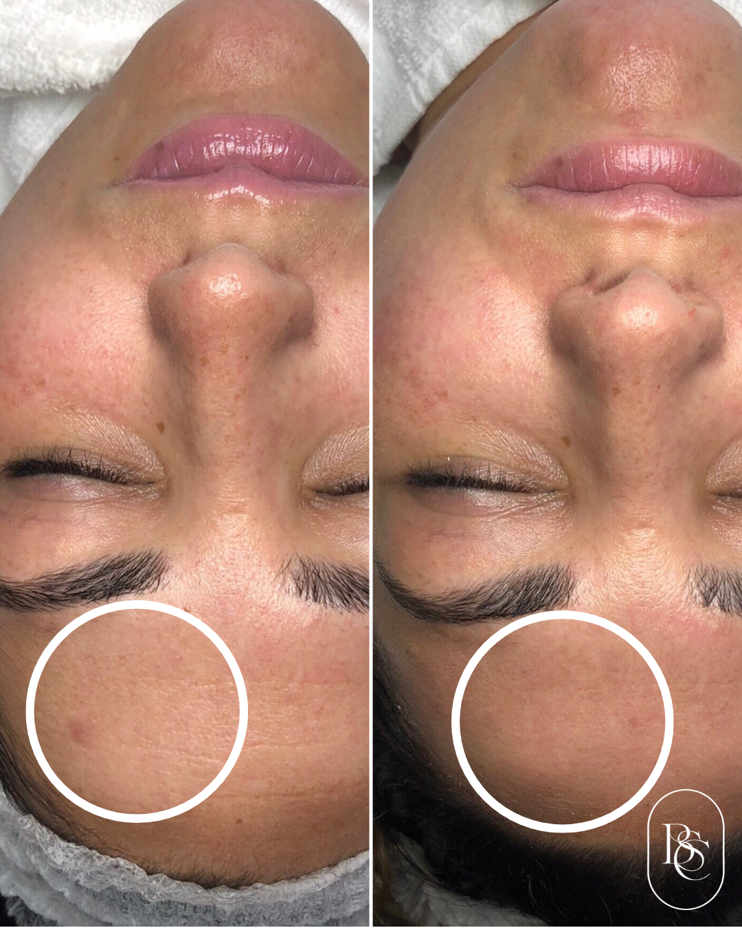Comparison of a person's face before and after a skincare treatment showing reduced redness and spots on the forehead around the circle area.