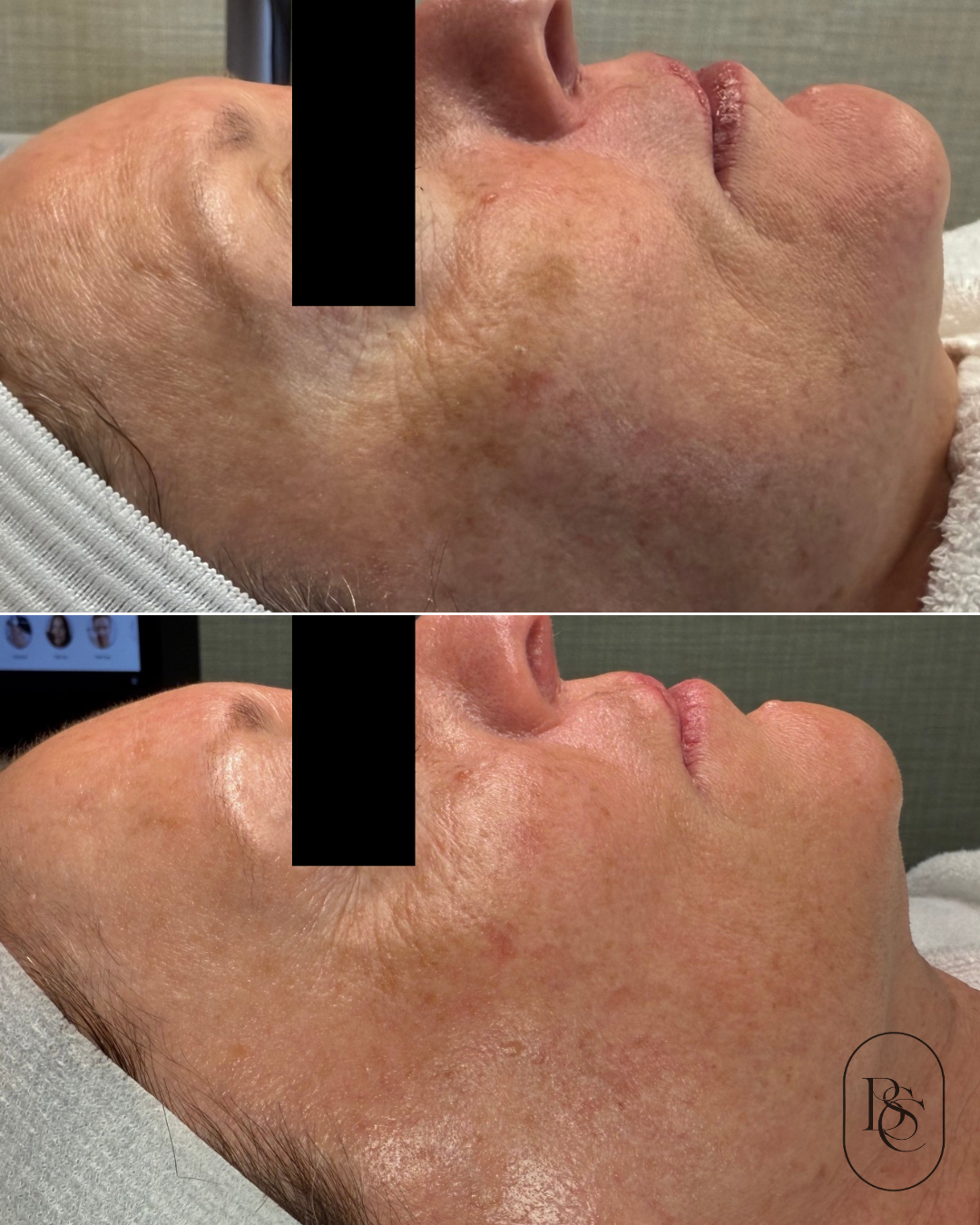 Close-up of a woman's face showing before and after skin treatment, highlighting improved skin texture, reduced pigmentation, and diminished wrinkles.