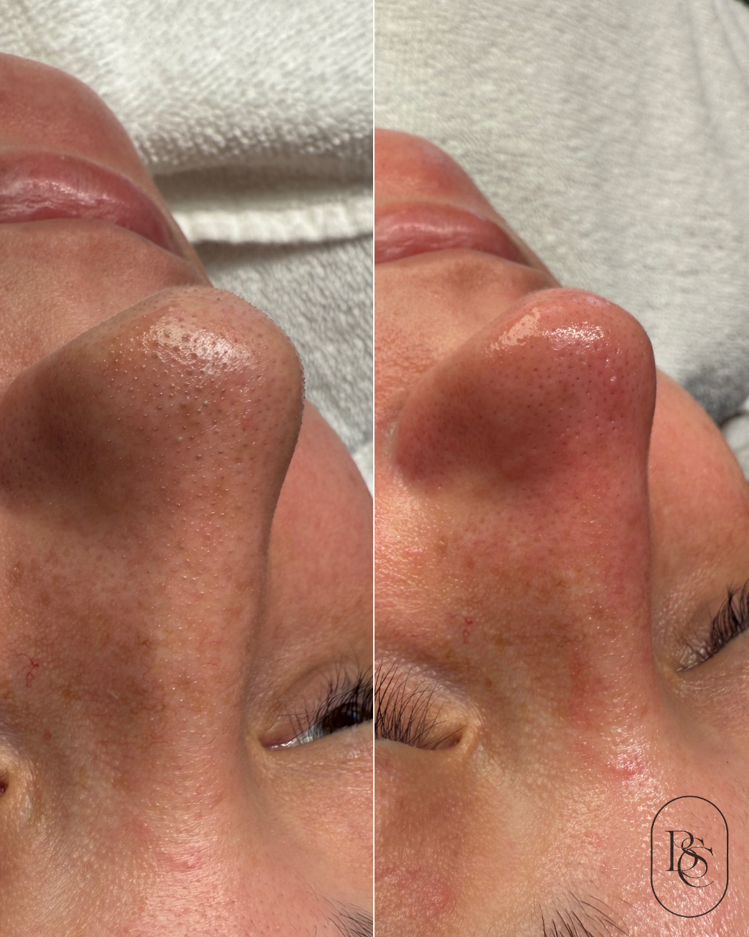 Close-up of a person's nose and face with visible pores, showing before and after images of skincare treatment for pore size reduction.