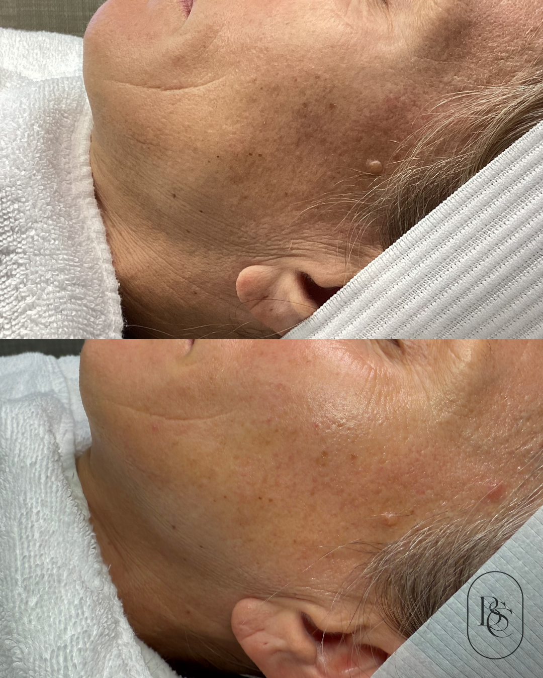 Close-up of a person's cheek and jaw before and after a skin treatment, showing reduced redness and improved skin texture.