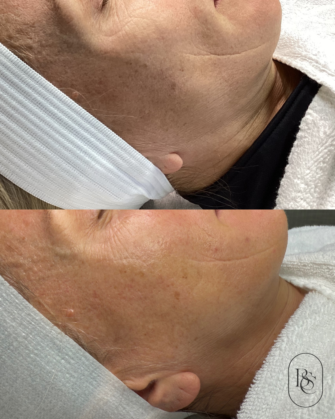 Before and after images of a person's lower face and neck showing skin improvement, likely from a skincare treatment.