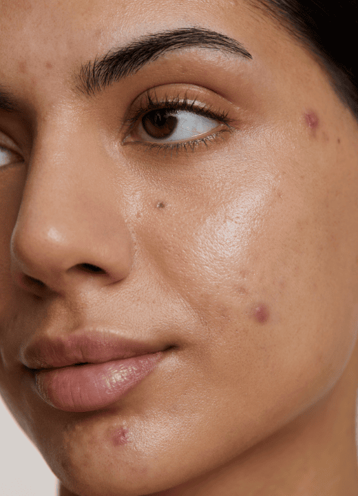 Close-up of a young woman's face showing acne and skin blemishes.